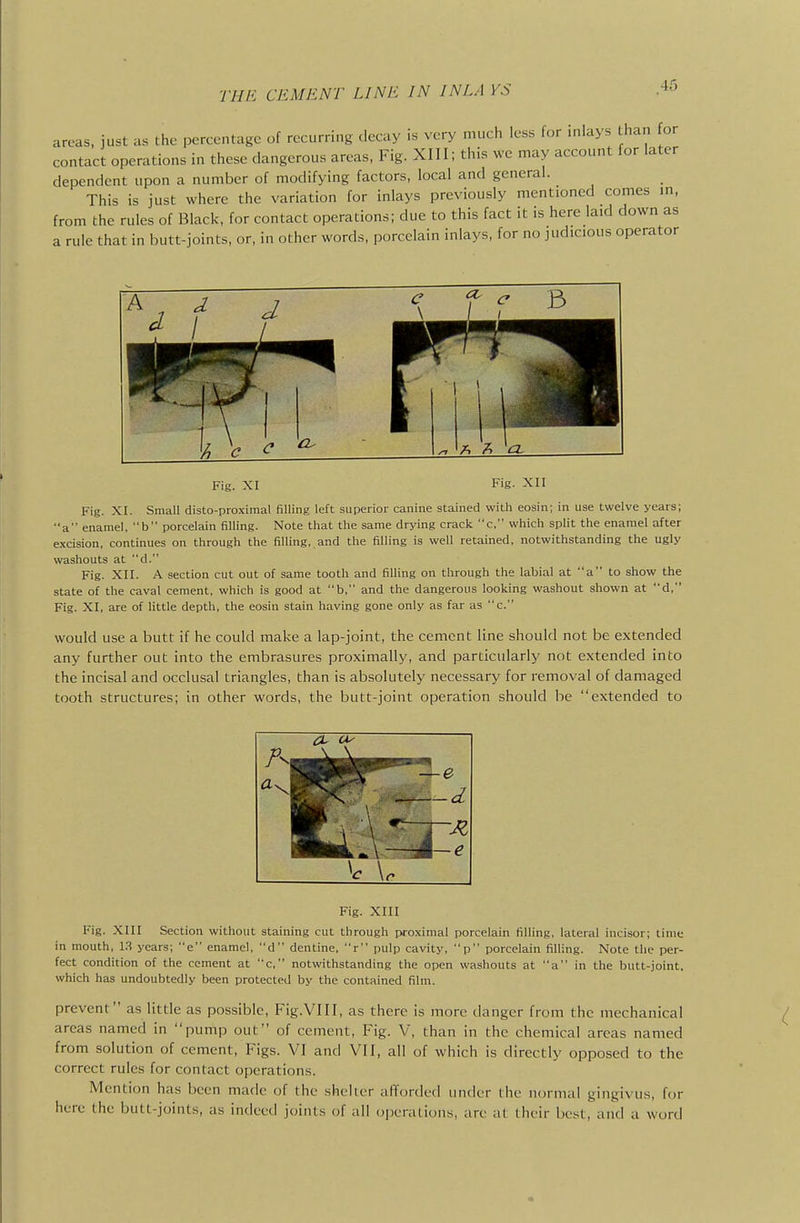 areas, just as the percentage of recurring decay is very much less for inlays than for contact operations in these dangerous areas, Fig. XIII; this we may account for later dependent upon a number of modifying factors, local and general. This is just where the variation for inlays previously mentioned comes m, from the rules of Black, for contact operations; due to this fact it is here laid down as a rule that in butt-joints, or, in other words, porcelain inlays, for no judicious operator 1^ g ^ Fig. XI Fig- XII Fig. XI. Small disto-proximal filling left superior canine stained with eosin; in use twelve years; a enamel, b porcelain filling. Note that the same drying crack c, which split the enamel after excision, continues on through the filling, and the filling is well retained, notwithstanding the ugly washouts at d. Fig. XII. A section cut out of same tooth and filling on through the labial at a to show the state of the caval cement, which is good at b, and the dangerous looking washout shown at d, Fig. XI, are of little depth, the eosin stain having gone only as far as c. would use a butt if he could make a lap-joint, the cement line should not be extended any further out into the embrasures proximally, and particularly not extended into the incisal and occlusal triangles, than is absolutely necessary for removal of damaged tooth structures; in other words, the butt-joint operation should be extended to Fig. XIII Fig. XIII Section without staining cut through proximal porcelain filling, lateral incisor; time in mouth, 13 years; e enamel, d dentine, r pulp cavity, p porcelain filling. Note the per- fect condition of the cement at c, notwithstanding the open washouts at a in the butt-joint, which has undoubtedly been protected by the contained film. prevent as little as possible, Fig.VIII, as there is more danger from the mechanical areas named in pump out of cement. Fig. V, than in the chemical areas named from solution of cement. Figs. VI and VII, all of which is directly opposed to the correct rules for contact operations. Mention has been made of the .shelter afforded under the normal gingivus, for here the butt-joints, as indeed joints of all operations, are at their best, and a word