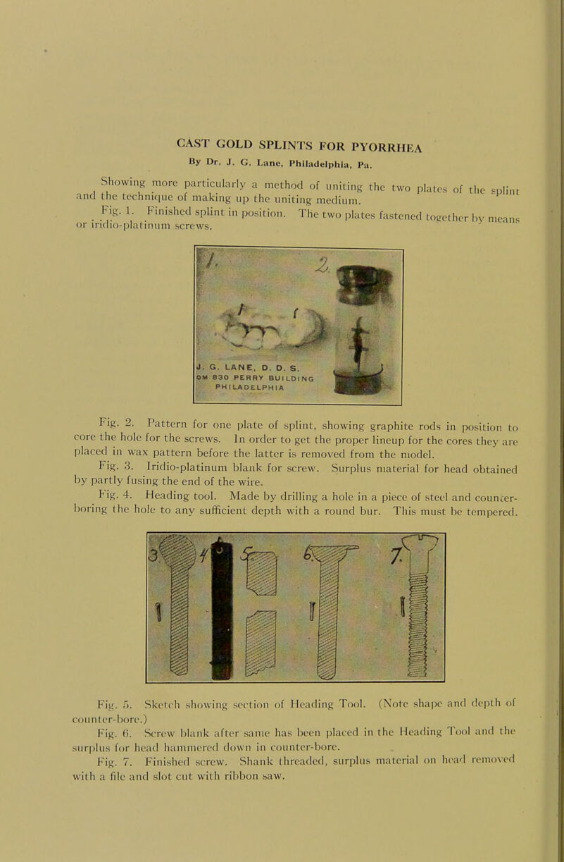 CAST GOLD SPLINTS FOR PYORRHEA By Dr. J. G. Lane, Philadelphia, Pa. Showing more particulorly a method of uniting the two plates of the =plint and the technique of maicing up the uniting medium. Fig. 1. Finished splint in position. The two plates fastened together hv means or indio-platiniim screws. J. G. LANE, D. D. S. OM 830 PERRY BUILDING PHILADELPHIA Fig. 2. Pattern for one plate of splint, showing graphite rods in position to core the hole for the screws. In order to get the proper lineup for the cores they are placed in wax pattern before the latter is removed from the model. Fig. 3. Iridio-platinum blank for screw. Surplus material for head obtained by partly fusing the end of the wire. lig. 4. Heading tool. Made by drilling a hole in a piece of steel and councer- boring the hole to any sufficient depth with a round bur. This must be tempered. Fig. r>. Sketch showing section of Heading Tool. (Note shape and ilepth of counter-bore.) Fig. 0. Screw blank after same has been iilaced in the Heading Tool and the surplus for head hammered down in counter-bore. Fig. 7. Finished screw. Shank threaded, surplus material on head removed with a flic and slot cut with ribbon saw.