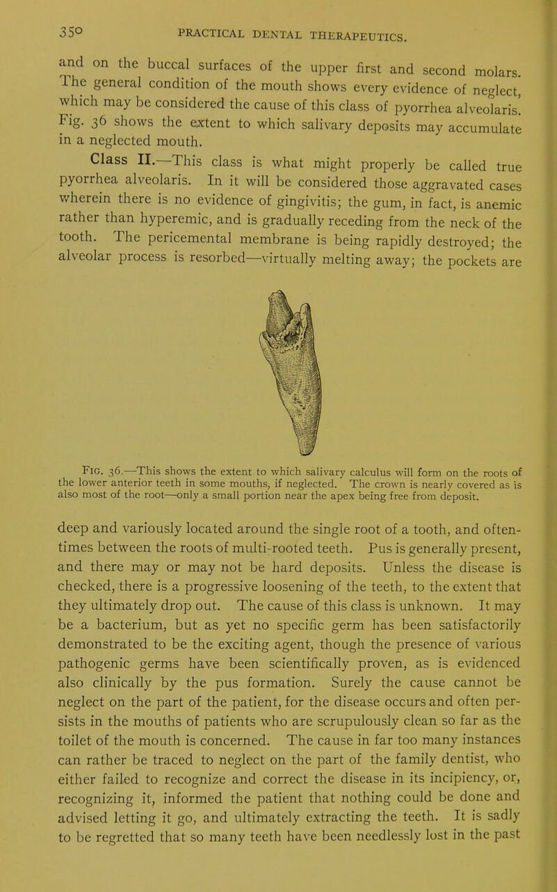 and on the buccal surfaces of the upper first and second molars. The general condition of the mouth shows every evidence of neglect, which may be considered the cause of this class of pyorrhea areolaris! Fig. 36 shows the extent to which salivary deposits may accumulate in a neglected mouth. Class II.—This class is what might properly be called true pyorrhea alveolaris. In it will be considered those aggravated cases wherein there is no evidence of gingivitis; the gum, in fact, is anemic rather than hyperemic, and is gradually receding from the neck of the tooth. The pericemental membrane is being rapidly destroyed; the alveolar process is resorbed—virtually melting away; the pockets are Fig. 36.—This shows the extent to which salivary calculus will form on the roots of the lower anterior teeth in some mouths, if neglected. The crown is nearly covered as is also most of the root—only a small portion near the apex being free from deposit. deep and variously located around the single root of a tooth, and often- times between the roots of multi-rooted teeth. Pus is generally present, and there may or may not be hard deposits. Unless the disease is checked, there is a progressive loosening of the teeth, to the extent that they ultimately drop out. The cause of this class is unknown. It may be a bacterium, but as yet no specific germ has been satisfactorily demonstrated to be the exciting agent, though the presence of various pathogenic germs have been scientifically proven, as is evidenced also clinically by the pus formation. Surely the cause cannot be neglect on the part of the patient, for the disease occurs and often per- sists in the mouths of patients who are scrupulously clean so far as the toilet of the mouth is concerned. The cause in far too many instances can rather be traced to neglect on the part of the family dentist, who either failed to recognize and correct the disease in its incipiency, or, recognizing it, informed the patient that nothing could be done and advised letting it go, and ultimately extracting the teeth. It is sadly to be regretted that so many teeth have been needlessly lost in the past