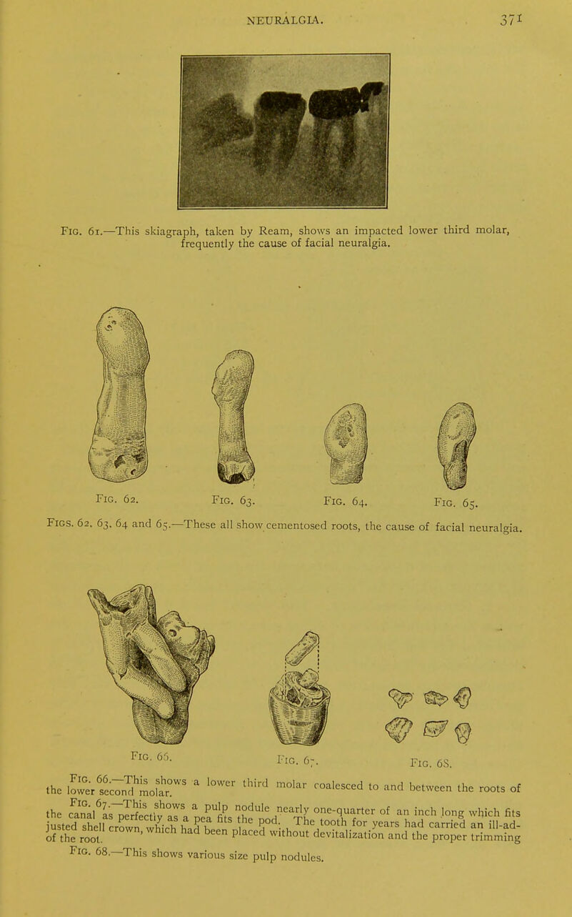 Fig. 61.—This skiagraph, taken by Ream, shows an impacted lower third molar, frequently the cause of facial neuralgia. Fig. 62. Fig. 6; Fig. 64. Fig. 65. Figs. 62. 63. 64 and 65.—These all show cementosed roots, the cause of facial neuralgia. Fig. 65. Fig. 6- Fig. 6S. the lower ?ec7ny.hrnoLhr°WS * ^ ^ C°^d t0 and bel™ the roots of the cFanal6L^Sictfv°aralA^^l ^^cr * an inch long which fits justedI shelrrw7wWrh LPl he f d- uThe t00th for vears had carried ^ ill-ad- of the root ' beCn P,aCed Wlth0Ut devitalization and the proper trimming Fig. 68—This shows various size pulp nodules.