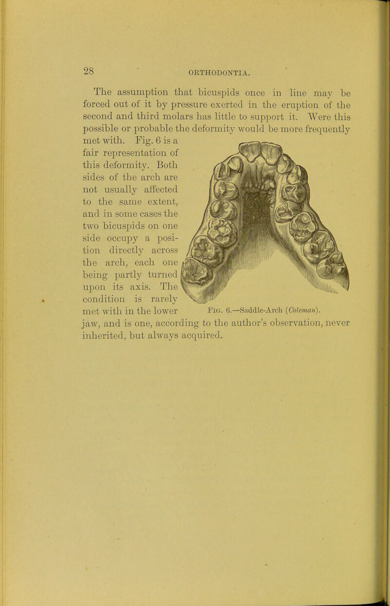 The assumption that bicuspids once in line may be forced out of it by pressure exerted in the eruption of the second and third molars has little to support it. Were this possible or probable the deformity would be more frequently met with. Fig. 6 is a fair representation of this deformity. Both sides of the arch are not usually affected to the same extent, and in some cases the two bicuspids on one side occupy a posi- tion directly across the arch, each one being partly turned upon its axis. The condition is rarely met with in the lower FlG. 6.—Saddle-Arch (Coleman). jaw, and is one, according to the author's observation, never inherited, but always acquired.