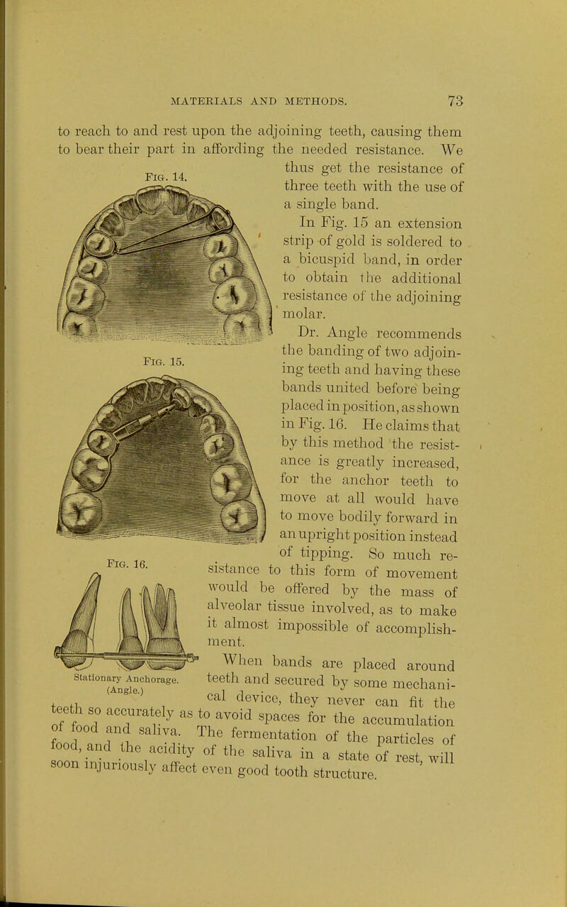 Fig. 15. to reach to and rest upon the adjoining teeth, causing them to bear their part in affording the needed resistance. We thus get the resistance of Fig. 14. three teeth with the use of a single band. In Fig. 15 an extension strip of gold is soldered to a bicuspid band, in order to obtain the additional resistance of the adjoining ' molar. Dr. Angle recommends the banding of two adjoin- ing teeth and having these bands united before being placed in position, as shown in Fig. 16. He claims that by this method the resist- ance is greatly increased, for the anchor teeth to move at all would have to move bodily forward in an upright position instead of tipping. So much re- sistance to this form of movement would be offered by the mass of alveolar tissue involved, as to make it almost impossible of accomplish- ment. When bands are placed around teeth and secured by some mechani- cal device, they never can fit the of Wl T i 7 S £ aV°id SpaCGS for the accumulation of food and saliva. The fermentation of the particles of food, and the acidity of the saliva in a state of res wil soon injuriously affect even good tooth structure Fig. 16. Stationary Anchorage. (Angle.)