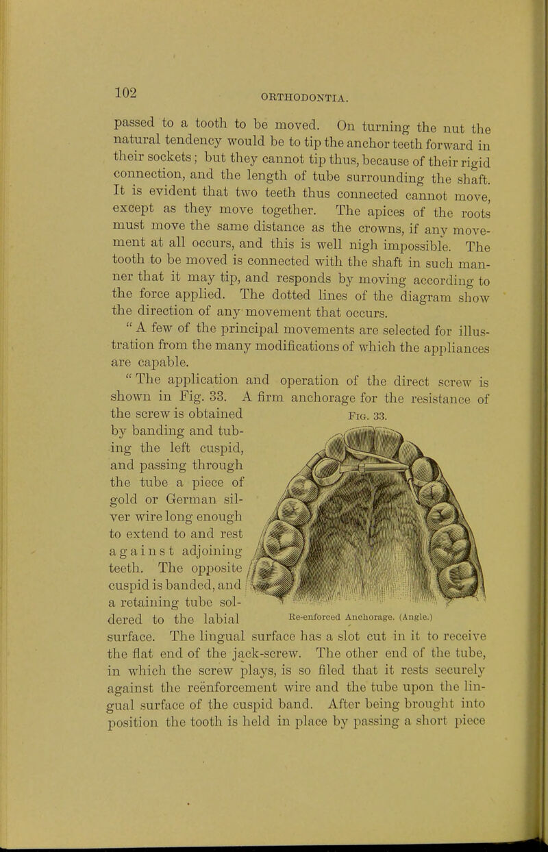 ORTHODONTIA. passed to a tooth to be moved. On turning the nut the natural tendency would be to tip the anchor teeth forward in their sockets; but they cannot tip thus, because of their rigid connection, and the length of tube surrounding the shaft. It is evident that two teeth thus connected cannot move, except as they move together. The apices of the roots must move the same distance as the crowns, if any move- ment at all occurs, and this is well nigh impossible. The tooth to be moved is connected with the shaft in such man- ner that it may tip, and responds by moving according to the force applied. The dotted lines of the diagram show the direction of any movement that occurs.  A few of the principal movements are selected for illus- tration from the many modifications of which the appliances are capable. The application and operation of the direct screw is shown in Fig. 33. A firm anchorage for the resistance of the screw is obtained fig. 33. by banding and tub- ing the left cuspid, and passiDg through the tube a piece of gold or German sil- ver wire long enough to extend to and rest against adjoining teeth. The opposite / cuspid is banded, and ; J a retaining tube sol- dered to the labial Re-enforced Anchorage. (Angle.) surface. The lingual surface has a slot cut in it to receive the flat end of the jack-screw. The other end of the tube, in which the screw plays, is so filed that it rests securely against the reenforcement wire and the tube upon the lin- gual surface of the cuspid band. After being brought into position the tooth is held in place by passing a shorl piece