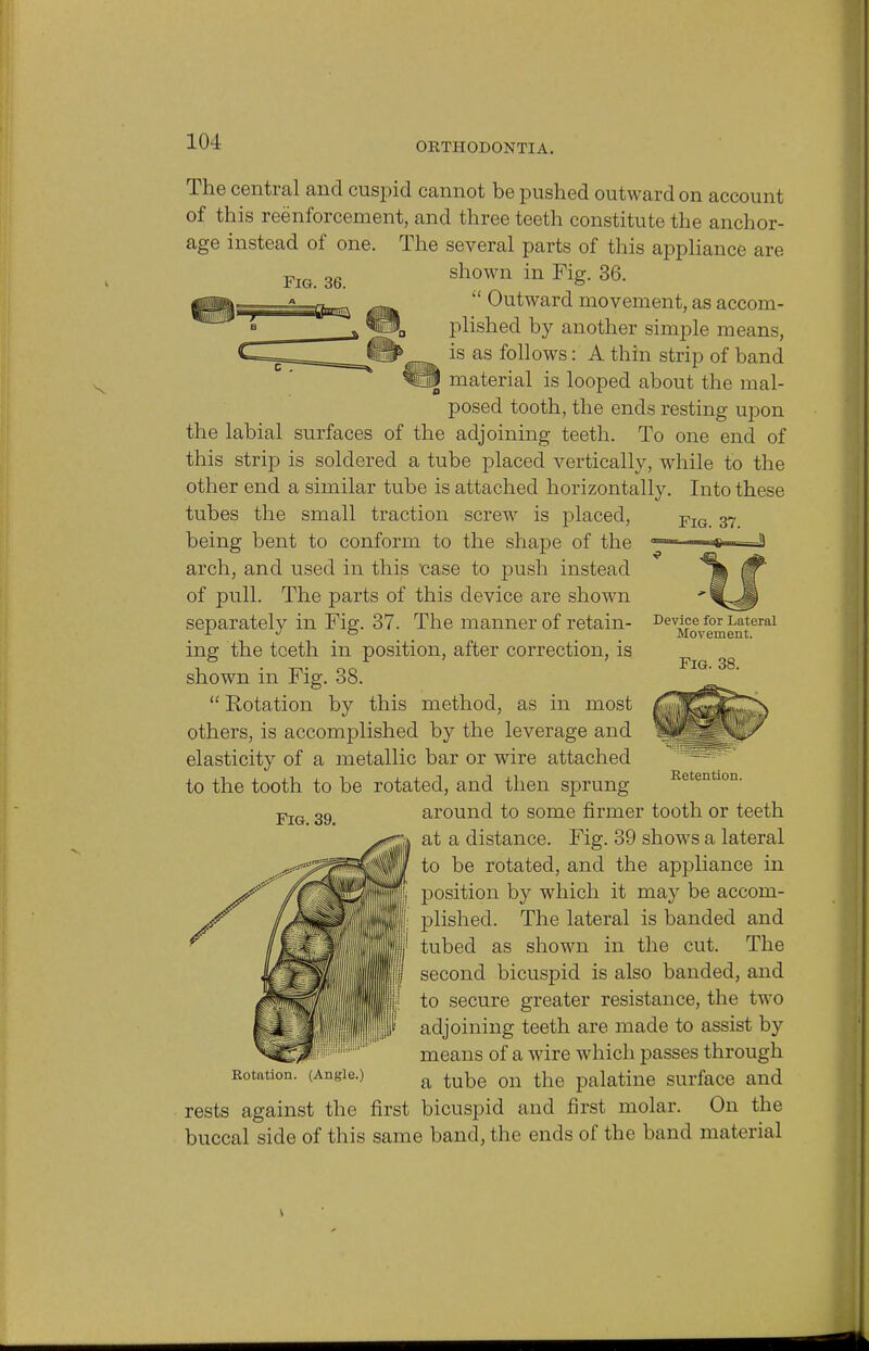 ORTHODONTIA. Fig Fig. 37. The central and cuspid cannot be pushed outward on account of this reenforcement, and three teeth constitute the anchor- age instead of one. The several parts of this appliance are shown in Fig. 36.  Outward movement, as accom- plished by another simple means, is as follows: A thin strip of band material is looped about the mal- posed tooth, the ends resting upon the labial surfaces of the adjoining teeth. To one end of this strip is soldered a tube placed vertically, while to the other end a similar tube is attached horizontally. Into these tubes the small traction screw is placed, being bent to conform to the shape of the arch, and used in this 'case to push instead of pull. The parts of this device are shown separately in Fig. 37. The manner of retain- ing the teeth in position, after correction, is shown in Fig. 38.  Rotation by this method, as in most others, is accomplished by the leverage and elasticity of a metallic bar or wire attached to the tooth to be rotated, and then sprung around to some firmer tooth or teeth at a distance. Fig. 39 shows a lateral to be rotated, and the appliance in position by which it may be accom- plished. The lateral is banded and tubed as shown in the cut. The second bicuspid is also banded, and to secure greater resistance, the two adjoining teeth are made to assist by means of a wire which passes through a tube on the palatine surface and rests against the first bicuspid and first molar. On the buccal side of this same band, the ends of the band material Device for Lateral Movement. Fig. 38. Retention. Fig. 39. Rotation. (Angle.)