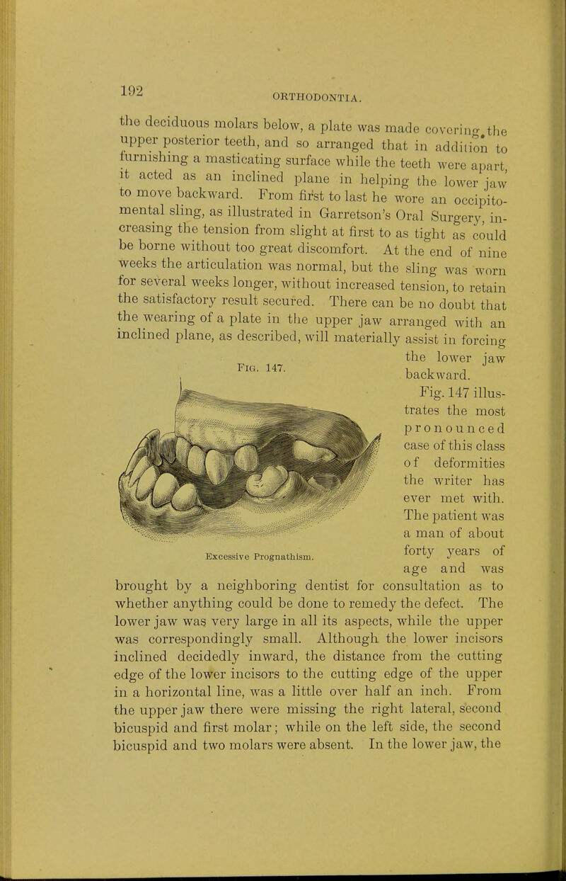 ORTHODONTIA. the deciduous molars below, a plate was made covering the upper posterior teeth, and so arranged that in addition to furnishing a masticating surface while the teeth were apart it acted as an inclined plane in helping the lower jaw to move backward. From first to last he wore an occipito- mental sling, as illustrated in Garretson's Oral Surgery, in- creasing the tension from slight at first to as tight as could be borne without too great discomfort. At the end of nine weeks the articulation was normal, but the sling was worn for several weeks longer, without increased tension, to retain the satisfactory result secured. There can be no doubt that the wearing of a plate in the upper jaw arranged with an inclined plane, as described, will materially assist in forcing the lower jaw Fig. 147. , , -. J backward. Fig. 147 illus- trates the most pronounced case of this class o f deformities the writer has ever met with. The patient was a man of about forty years of age and was brought by a neighboring dentist for consultation as to whether anything could be done to remedy the defect. The lower jaw was very large in all its aspects, while the upper was correspondingly small. Although the lower incisors inclined decidedly inward, the distance from the cutting edge of the lower incisors to the cutting edge of the upper in a horizontal line, was a little over half an inch. From the upper jaw there were missing the right lateral, second bicuspid and first molar; while on the left side, the second bicuspid and two molars were absent. In the lower jaw, the Excessive Prognathism.