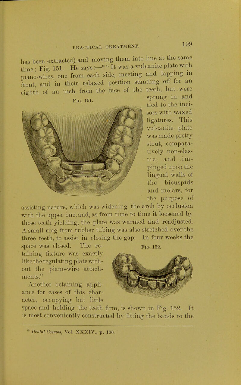199 Fig. 151. has been extracted) and moving them into line at the same time • Fio- 151. He says:—*  It was a vulcanite plate with piano-wires, one from each side, meeting and lapping m front and in their relaxed position standing off for an eighth of an inch from the face of the teeth, but were sprung in and tied to the inci- sors with waxed ligatures. This vulcanite plate was made pretty stout, compara- tively non-elas- tic, and im- pinged upon the lingual walls of the bicuspids and molars, for the purpose of assisting nature, which was widening the arch by occlusion with the upper one, and, as from time to time it loosened by those teeth yielding, the plate was warmed and readjusted. A small ring from rubber tubing was also stretched over the three teeth, to assist in closing the gap. In four weeks the space was closed. The re- Fig. 152. taining fixture was exactly like the regulating plate with- out the piano-wire attach- ments. Another retaining appli- ance for cases of this char- acter, occupying but little space and holding the teeth firm, is shown in Fig. 152. It is most conveniently constructed by fitting the bands to the