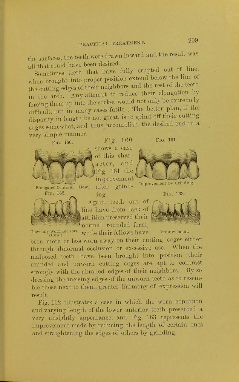 PR A CTIC A L TREATM EN T. Fig. 162. the surfaces, the teeth were drawn inward and the result was all that could have been desired. Sometimes teeth that have fully erupted out of line when brought into proper position extend below the lme of the cutting edges of their neighbors and the rest of the teeth in the arch. Any attempt to reduce their elongation by forcing them up into the socket would not only be extremely difficult, but in many cases futile. . The better plan, if the disparity in length be not great, is to grind off their cutting edges somewhat, and thus 'accomplish the desired end m a very simple manner. FIG. ieo. Fig. 160 Fig. 161. shows a case of this char- acter, and J Fig. 161 the improvement Elongated Centrals. (How.) after grind- ing. Again, teeth out of line have from lack of I attrition preserved their 'normal, rounded form, Unevenly Worn Incisors. wn]le fellows have Improvement. been more or less worn away on their cutting edges either through abnormal occlusion or excessive use. When the malposed teeth have been brought into position their rounded and unworn cutting edges are apt to contrast strongly with the abraded edges of their neighbors. By so dressing the incising edges of the unworn teeth as to resem- ble those next to them, greater Harmony of expression will result. Fig. 162 illustrates a case in which the worn condition and varying length of the lower anterior teeth presented a very unsightly appearance, and Fig. 163 represents the improvement made by reducing the length of certain ones and straightening the edges of others by grinding. Improvement by Grinding. Fig. 163.
