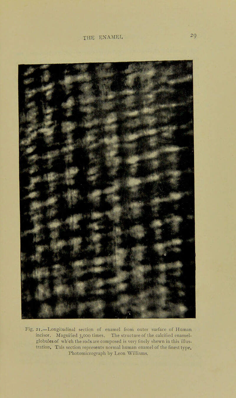 the; rname;!. Fig. 21,—Longitudinal section of enamel from outer surface of Human incisor. Magnified 3,000 times. The structure of tlie calcified enamel- globules of wh'ch the rods are composed is very finely shewn in this illus- tration. This section represents normal human enamel of the finest type. Photomicrograph by Leon Williams.