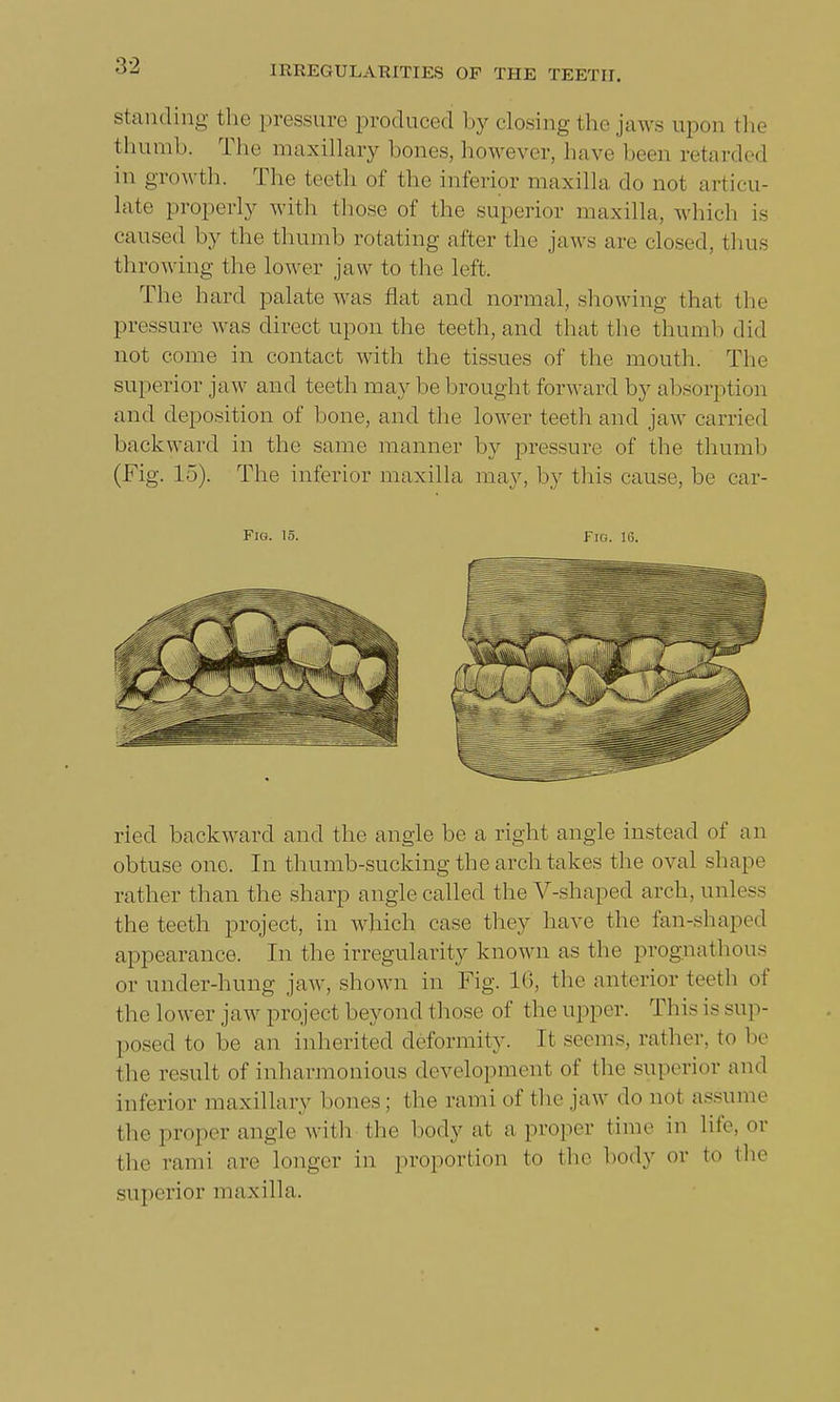 standing the pressure produced by closing the jaws upon the thumb. The maxillary bones,however, have been retarded in growth. The teeth of the inferior maxilla do not articu- late properly with those of the superior maxilla, which is caused by the thumb rotating after the jaws are closed, thus throwing the lower jaw to the left. The hard palate was flat and normal, showing that the pressure was direct upon the teeth, and that the thumb did not come in contact with the tissues of the mouth. The superior jaw and teeth may be brought forward by absorption and deposition of bone, and the lower teeth and jaw carried backward in the same manner by pressure of the thumb (Fig. 15). The inferior maxilla may, by this cause, be car- FlG. 15. FIG. 16. rled backward and the angle be a right angle instead of an obtuse one. In thumb-sucking the arch takes the oval shape rather than the sharp angle called the V-shaped arch, unless the teeth project, in which ease they have the fan-shaped appearance. In the irregularity known as the prognathous or under-hung jaw, shown in Fig. 16, the anterior teeth of the lower jaw project beyond those of the upper. This is sup- posed to be an inherited deformity. It seems, rather, to be the result of inharmonious development of tie- superior and inferior maxillary bones; the rami of the jaw do not assume the proper angle with the body at a proper time in life, or the rand are longer in proportion to the body or to the superior maxilla.