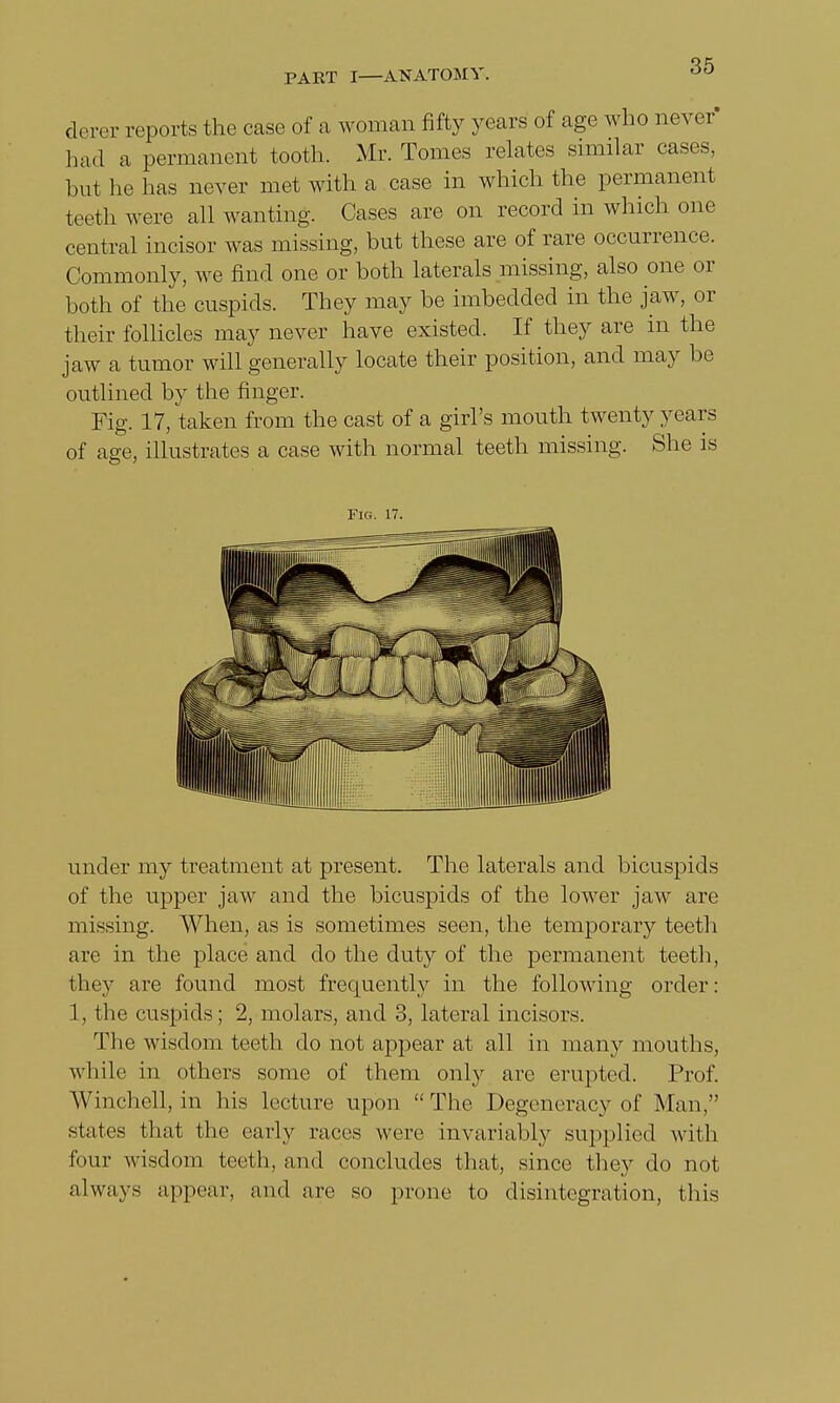 derer reports the case of a woman fifty years of age who never had a permanent tooth. Mr. Tomes relates similar cases, but he has never met with a case in which the permanent teeth were all wanting. Cases are on record in which one central incisor was missing, but these are of rare occurrence. Commonly, we find one or both laterals missing, also one or both of the cuspids. They may be imbedded in the jaw, or their follicles may never have existed. If they are in the jaw a tumor will generally locate their position, and may be outlined by the finger. Fig. 17, taken from the cast of a girl's mouth twenty years of age, illustrates a case with normal teeth missing. She is Fig. 17. under my treatment at present. The laterals and bicuspids of the upper jaw and the bicuspids of the lower jaw are missing. When, as is sometimes seen, the temporary teeth are in the place and do the duty of the permanent teeth, they are found most frequently in the following order: 1, the cuspids; 2, molars, and 3, lateral incisors. The wisdom teeth do not appear at all in many mouths, while in others some of them only are erupted. Prof. Wmchell, in his lecture upon The Degeneracy of Man, states that the early races were invariably supplied with four wisdom teeth, and concludes that, since they do not always appear, and are so prone to disintegration, this