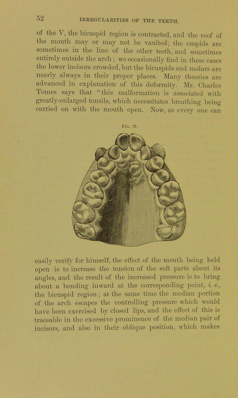 of the V, the bicuspid region is contracted, and the roof of the mouth may or may not he vaulted; the cuspids are sometimes in the line of the other teeth, and sometimea entirely outside the arch; we occasionally find in these cases the lower incisors crowded, but the bicuspids and molars are nearly always in their proper places. Many theories are advanced in explanation of this deformity. Mr. Charles Tomes says that this malformation is associated with greatly-enlarged tonsils, which necessitates breathing being carried on with the mouth open. Now, as every one can Fio. 27. open is to increase the tension of the soft parts about its angles, and the result of the increased pressure is to bring about a bending inward at the corresponding point, i. c the bicuspid region; at the same time the median portion of the arch escapes the controlling pressure which would have been exercised by closed lips, and the effed of this is traceable in the excessive prominence of the median pair of incisors, and also in their oblique position, which makes