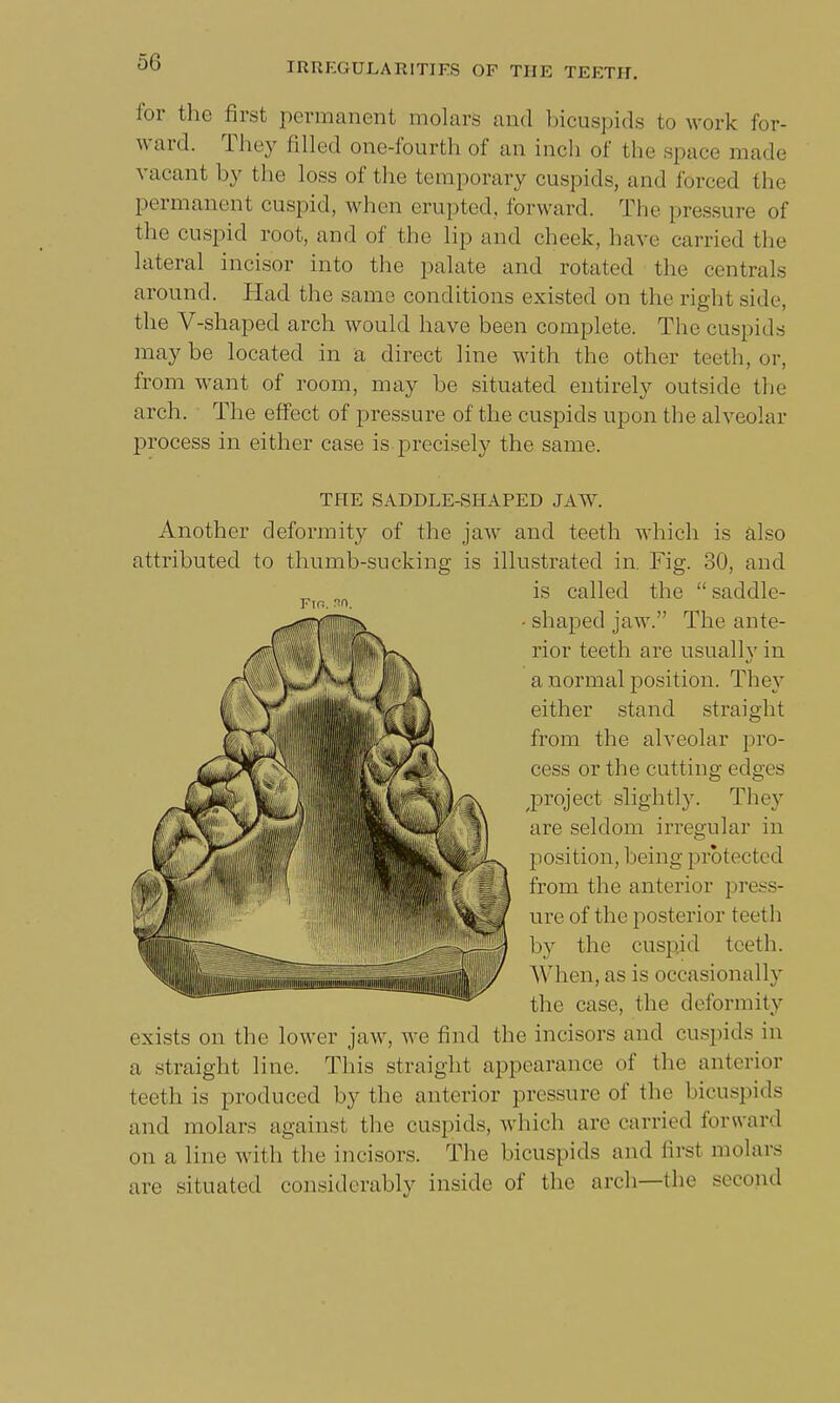 for the first permanent molars and bicuspids to work for- ward. They Idled one-fourth of an inch of the space made vacant by the loss of the temporary cuspids, and forced the permanent cuspid, when erupted, forward. The pressure of the cuspid root, and of the lip and cheek, have carried the lateral incisor into the palate and rotated the centrals around. Had the same conditions existed on the right side, the V-shaped arch would have been complete. The cuspids may be located in a direct line with the other teeth, or, from want of room, may be situated entirely outside the arch. The effect of pressure of the cuspids upon the alveolar process in either case is precisely the same. THE SADDLE-SHAPED JAW. Another deformity of the jaw and teeth which is also attributed to thumb-sucking is illustrated in. Fig. 30, and is called the  saddle- - shaped jaw. The ante- rior teeth are usuallv in a normal position. They either stand straight from the alveolar pro- cess or the cutting edges project slightly. They are seldom irregular in position, being protected from the anterior press- ure of the posterior teeth by the cuspid teeth. When, as is occasionally the case, the deformity exists on the lower jaw, we find the incisors and cuspids in a straight line. This straight appearance of the anterior teeth is produced by the anterior pressure of the bicuspids and molars against the cuspids, which are carried forward on a line with the incisors. The bicuspids and firsl molars are situated considerably inside of the arch—the second
