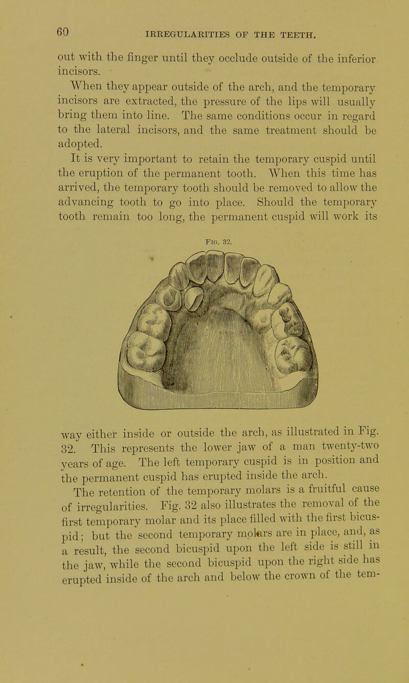 out with the finger until they occlude outside of the inferior incisors. When they appear outside of the arch, and the temporary incisors are extracted, the pressure of the lips will usually bring them into line. The same conditions occur in regard to the lateral incisors, and the same treatment should be adopted. It is very important to retain the temporary cuspid until the eruption of the permanent tooth. When this time has arrived, the temporary tooth should be removed to allow the advancing tooth to go into place. Should the temporary tooth remain too long, the permanent cuspid will work its Fin. 32. way either inside or outside the arch, as illustrated in Fig. 32. This represents the lower jaw of a man twenty-two years of age. The left temporary cuspid is in position and the permanent cuspid has erupted inside the arch. The retention of the temporary molars is a fruitful cause of irregularities. Fig. 32 also illustrates the removal of the first temporary molar and its place filled with the first bicus- pid; but the second temporary motors are in place, and, as a result, the second bicuspid upon the left side is still in the jaw, while the second bicuspid upon the righi side has erupted inside of the arch and below the crown of the tern-