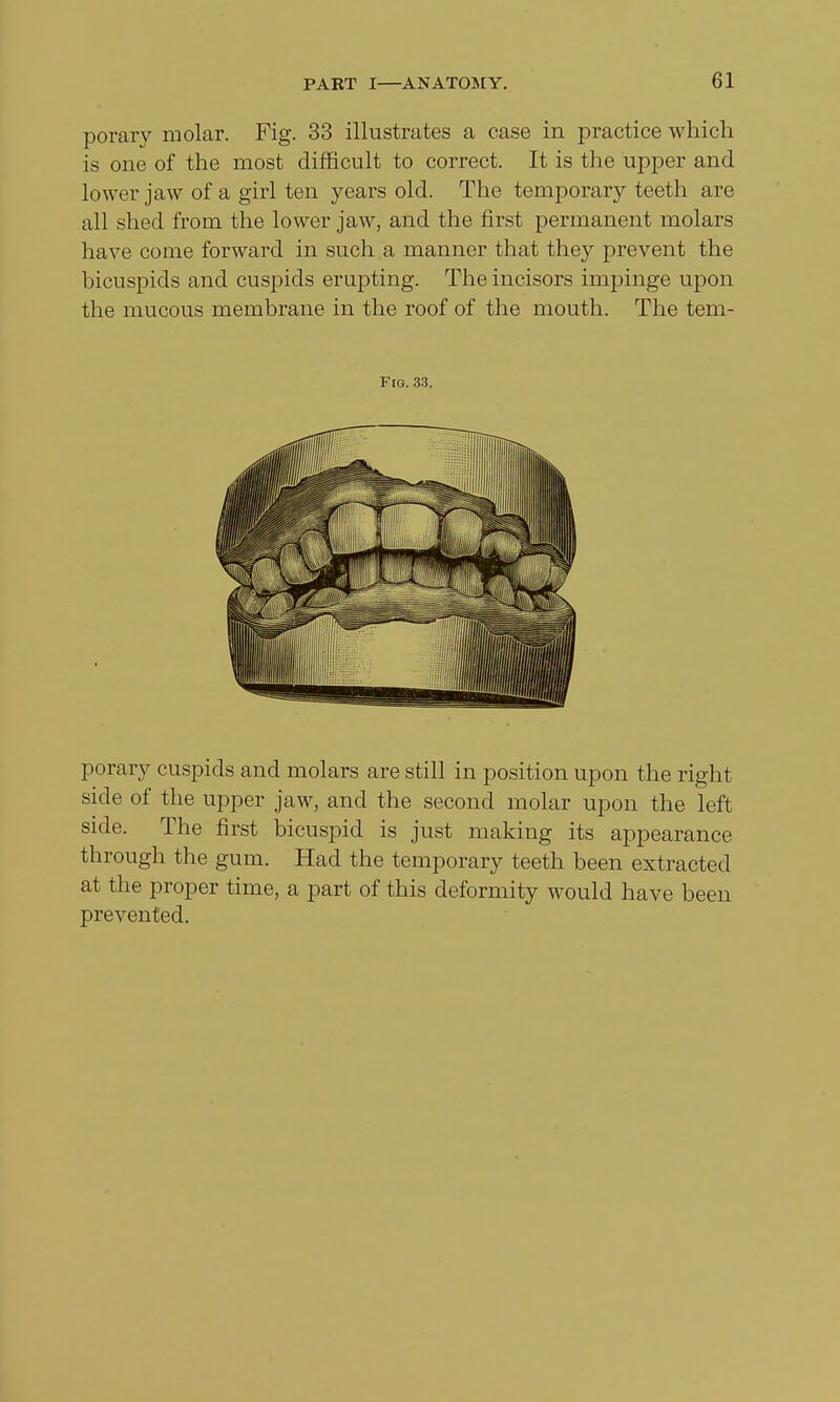porary molar. Fig. 33 illustrates a case in practice which is one of the most difficult to correct. It is the upper and lower jaw of a girl ten years old. The temporary teeth are all shed from the lower jaw, and the first permanent molars have come forward in such a manner that they prevent the bicuspids and cuspids erupting. The incisors impinge upon the mucous membrane in the roof of the mouth. The tem- Fig. 33. porary cuspids and molars are still in position upon the right side of the upper jaw, and the second molar upon the left side. The first bicuspid is just making its appearance through the gum. Had the temporary teeth been extracted at the proper time, a part of this deformity would have been prevented.