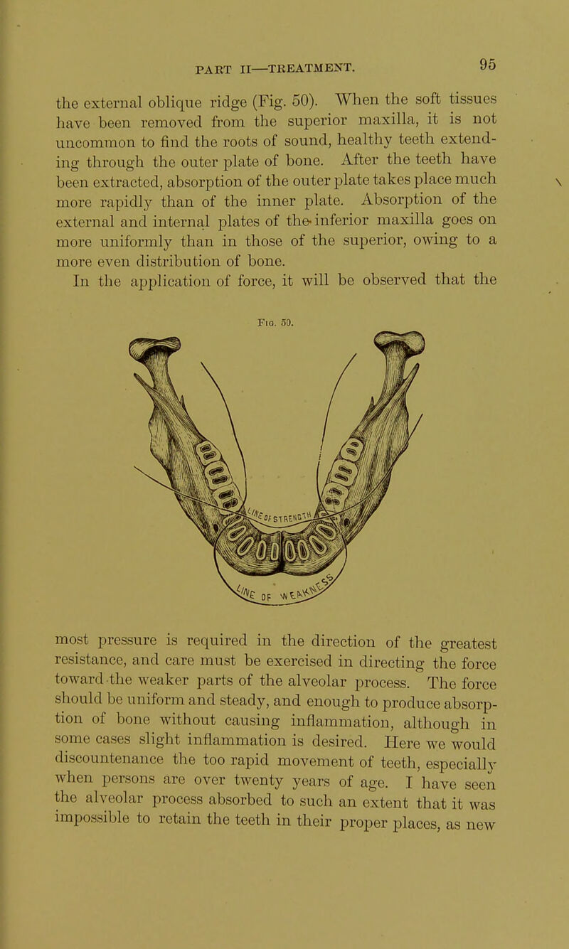the exte rnal oblique ridge (Fig. 50). When the soft tissues have been removed from the superior maxilla, it is not uncommon to find the roots of sound, healthy teeth extend- ing through the outer plate of bone. After the teeth have been extracted, absorption of the outer plate takes place much \ more rapidly than of the inner plate. Absorption of the external and internal plates of the-inferior maxilla goes on more uniformly than in those of the superior, owing to a more even distribution of bone. In the application of force, it will be observed that the Fio. 50. most pressure is required in the direction of the greatest resistance, and care must be exercised in directing the force toward the weaker parts of the alveolar process. The force should be uniform and steady, and enough to produce absorp- tion of bone without causing inflammation, although in some cases slight inflammation is desired. Here we would discountenance the too rapid movement of teeth, especially when persons are over twenty years of age. I have seen the alveolar process absorbed to such an extent that it was impossible to retain the teeth in their proper places, as new