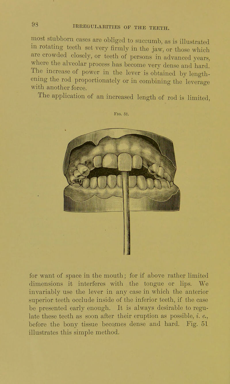 93 most stubborn cases are obliged to succumb, as is illustrated in rotating teeth set very firmly in the jaw, or those which are crowded closely, or teeth of persons in advanced years, where the alveolar process has become very dense and hard. The increase of power in the lever is obtained by length- ening the rod proportionately or in combining the leverage with another force. The application of an increased length of rod is limited, Fig. 51. for want of space in the mouth; for if above rather limited dimensions it interferes with the tongue or lips. We invariably use the lever in any case in which the anterior superior teeth occlude inside of the inferior teeth, if the case be presented early enough. It is always desirable to regu- late these teeth as soon after their eruption as possible, i. e., before the bony tissue becomes dense and hard. Fig. 51 illustrates this simple method.