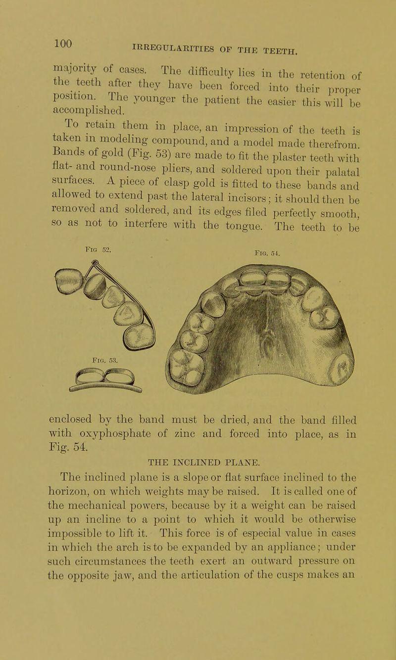 IRREGULARITIES OF THE TEETH. majority of cases The difficulty lies in the retention of the teeth after they have been forced into their proper position The younger the patient the easier this will be accomplished. To retain them in place, an impression of the teeth is taken m modeling compound, and a model made therefrom Bands of gold (Fig. 53) are made to fit the plaster teeth with flat- and round-nose pliers, and soldered upon their palatal surfaces. A piece of clasp gold is fitted to these bands and allowed to extend past the lateral incisors; it should then be removed and soldered, and its edges filed perfectly smooth, so as not to interfere with the tongue. The teeth to be Fig 52. Fig. 54. enclosed by the band must be dried, and the band filled with oxyphosphate of zinc and forced into place, as in Fig. 54. THE INCLINED PLANE. The inclined plane is a slope or flat surface inclined to the horizon, on which weights may be raised. It is called one of the mechanical powers, because by it a weight can be raised up an incline to a point to which it would be otherwise impossible to lift it. This force is of especial value in cases in which the arch is to be expanded by an appliance; under such circumstances the teeth exert an outward pressure on the opposite jaw, and the articulation of the cusps makes an
