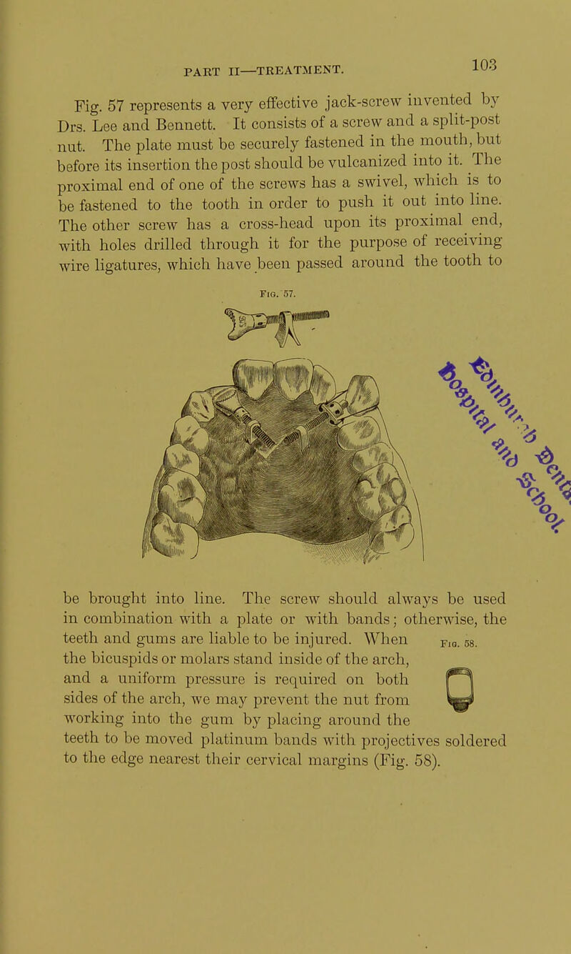 Fig. 57 represents a very effective jack-screw invented by Drs. Lee and Bennett. It consists of a screw and a split-post nut. The plate must be securely fastened in the mouth, but before its insertion the post should be vulcanized into it. The proximal end of one of the screws has a swivel, which is to be fastened to the tooth in order to push it out into line. The other screw has a cross-head upon its proximal end, with holes drilled through it for the purpose of receiving wire ligatures, which have been passed around the tooth to Fig. 57. be brought into line. The screw should always be used in combination with a plate or with bands; otherwise, the teeth and gums are liable to be injured. When the bicuspids or molars stand inside of the arch, and a uniform pressure is required on both sides of the arch, we may prevent the nut from working into the gum by placing around the teeth to be moved platinum bands with projectives soldered to the edge nearest their cervical margins (Fig. 58).