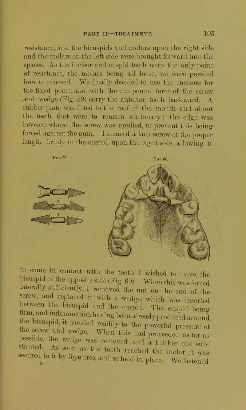 resistance, and the bicuspids and molars upon the right side and the molars on the left side were brought forward into the spaces. As the incisor and cuspid teeth were the only point of resistance, the molars being all loose, we were puzzled how to proceed. We finally decided to use the incisors for the fixed point, and with the compound force of the screw and wedge (Fig. 59) carry the anterior teeth backward. A rubber plate was fitted to the roof of the mouth and about the teeth that were to remain stationary; the edge was beveled where the screw was applied, to prevent this being forced against the gum. I secured a jack-screw of the proper length firmly to the cuspid upon the right side, allowing it Fig. 59. Fir. 60. to come m contact with the tooth I wished to move the bicuspid of the opposite side (Fig. 60). When this was forced laterally sufficiently, I removed the nut on the end of the screw, and replaced it with a wedge, which was inserted between the bicuspid and the cuspid. The cuspid being firm and inflammation having been already produced around he bicuspid, it yielded readily to the powerful pressure of ZZrZ WhGn this had P-eoeded as far as stitu o 1 A ^ rCm°Ved and a thickGr sub- stituted. As soon as the tooth reached the molar it was secureo^to it by ligatures, and so held in place. wlZ