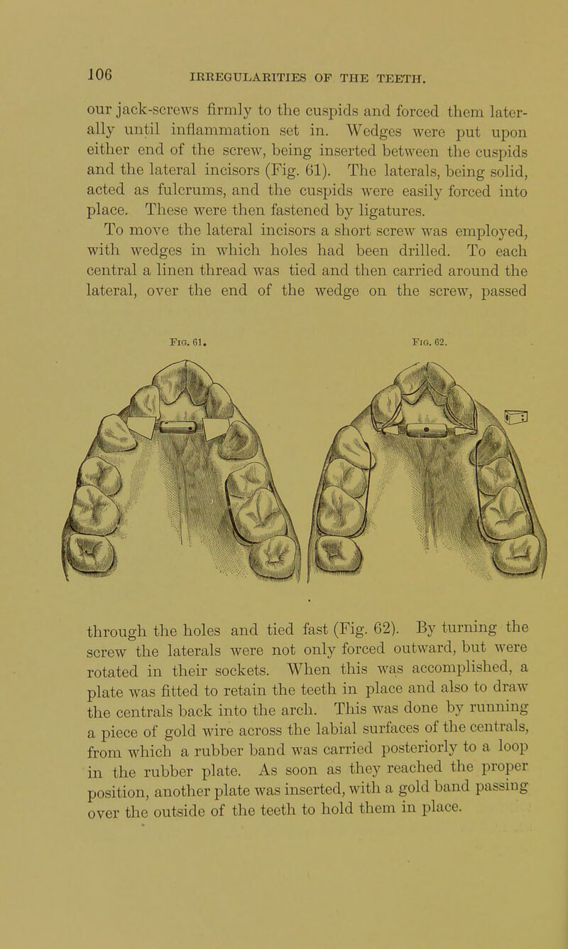 our jack-screws firmly to the cuspids and forced them later- ally until inflammation set in. Wedges were put upon either end of the screw, being inserted between the cuspids and the lateral incisors (Fig. 61). The laterals, being solid, acted as fulcrums, and the cuspids were easily forced into place. These were then fastened by ligatures. To move the lateral incisors a short screw was employed, with wedges in which holes had been drilled. To each central a linen thread was tied and then carried around the lateral, over the end of the wedge on the screw, passed Fio. 61. Fig. 62. through the holes and tied fast (Fig. 62). By turning the screw the laterals were not only forced outward, but were rotated in their sockets. When this was accomplished, a plate was fitted to retain the teeth in place and also to draw the centrals back into the arch. This was done by running a piece of gold wire across the labial surfaces of the centrals, from which a rubber band was carried posteriorly to a loop in the rubber plate. As soon as they reached the proper position, another plate was inserted, with a. gold band passing- over the outside of the teeth to hold them in place.
