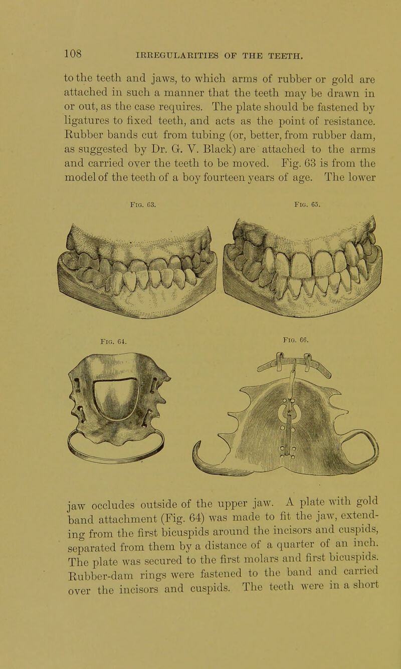 to the teeth and jaws, to which arms of rubber or gold are attached in such a manner that the teeth may be drawn in or out, as the case requires. The plate should be fastened by ligatures to fixed teeth, and acts as the point of resistance. Rubber bands cut from tubing (or, better, from rubber dam, as suggested by Dr. G. V. Black) are attached to the arms and carried over the teeth to be moved. Fig. 63 is from the model of the teeth of a boy fourteen years of age. The lower Fig. C3. Fig. 65. Fig. 66. jaw occludes outside of the upper jaw. A plate with gold band attachment (Fig. 64) was made to fit the jaw, extend- ing from the first bicuspids around the incisors and cuspids, separated from them by a distance of a quarter of an inch. The plate was secured to the first molars and first bicuspids. Rubber-dam rings were fastened to the band and carried over the incisors and cuspids. The teeth were in a short