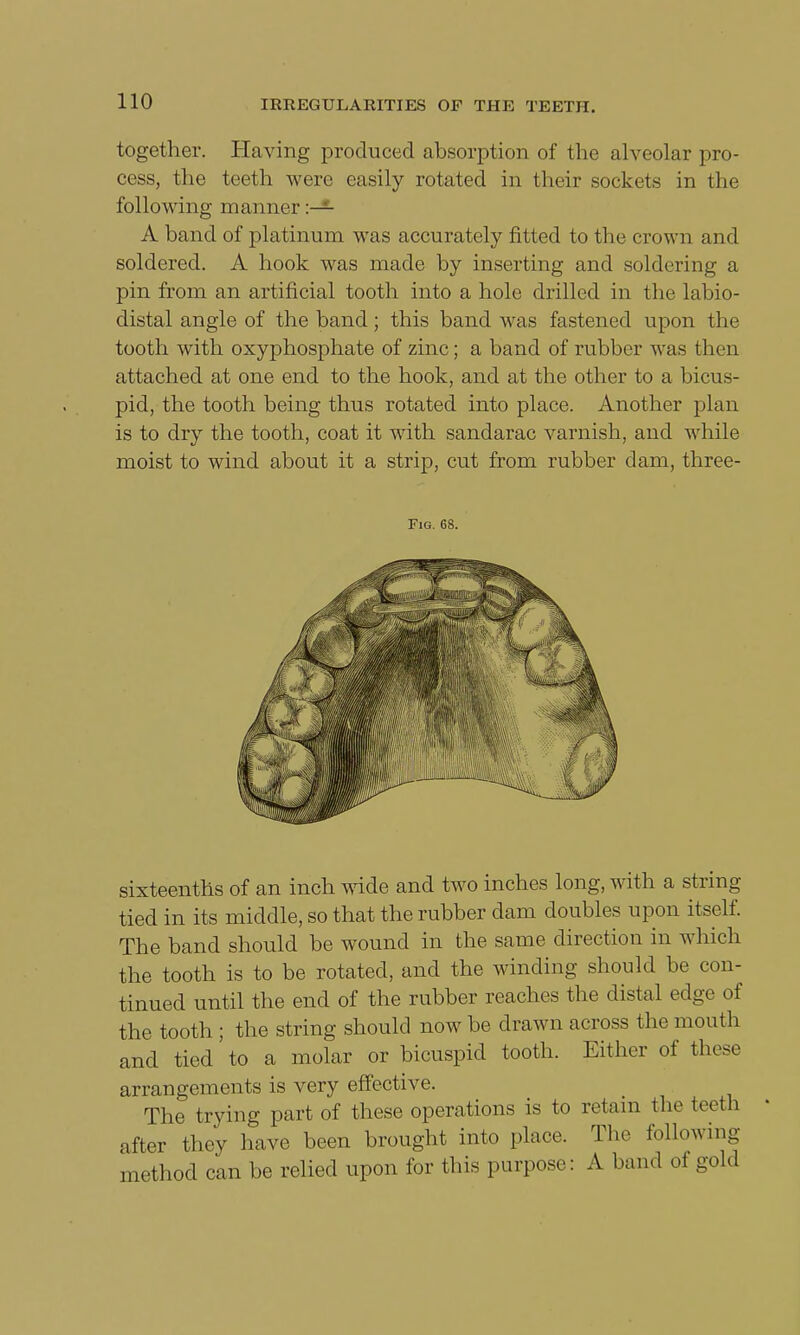 together. Having produced absorption of the alveolar pro- cess, the teeth were easily rotated in their sockets in the following manner :— A band of platinum was accurately fitted to the crown and soldered. A hook was made by inserting and soldering a pin from an artificial tooth into a hole drilled in the labio- distal angle of the band; this band was fastened upon the tooth with oxyphosphate of zinc; a band of rubber was then attached at one end to the hook, and at the other to a bicus- pid, the tooth being thus rotated into place. Another plan is to dry the tooth, coat it with sandarac varnish, and while moist to wind about it a strip, cut from rubber dam, three- sixteenths of an inch wide and two inches long, with a string tied in its middle, so that the rubber dam doubles upon itself. The band should be wound in the same direction in which the tooth is to be rotated, and the winding should be con- tinued until the end of the rubber reaches the distal edge of the tooth ; the string should now be drawn across the mouth and tied to a molar or bicuspid tooth. Either of these arrangements is very effective. The trying part of these operations is to retain the teeth after they have been brought into place. The following method can be relied upon for this purpose: A band of gold Fig. 6S.