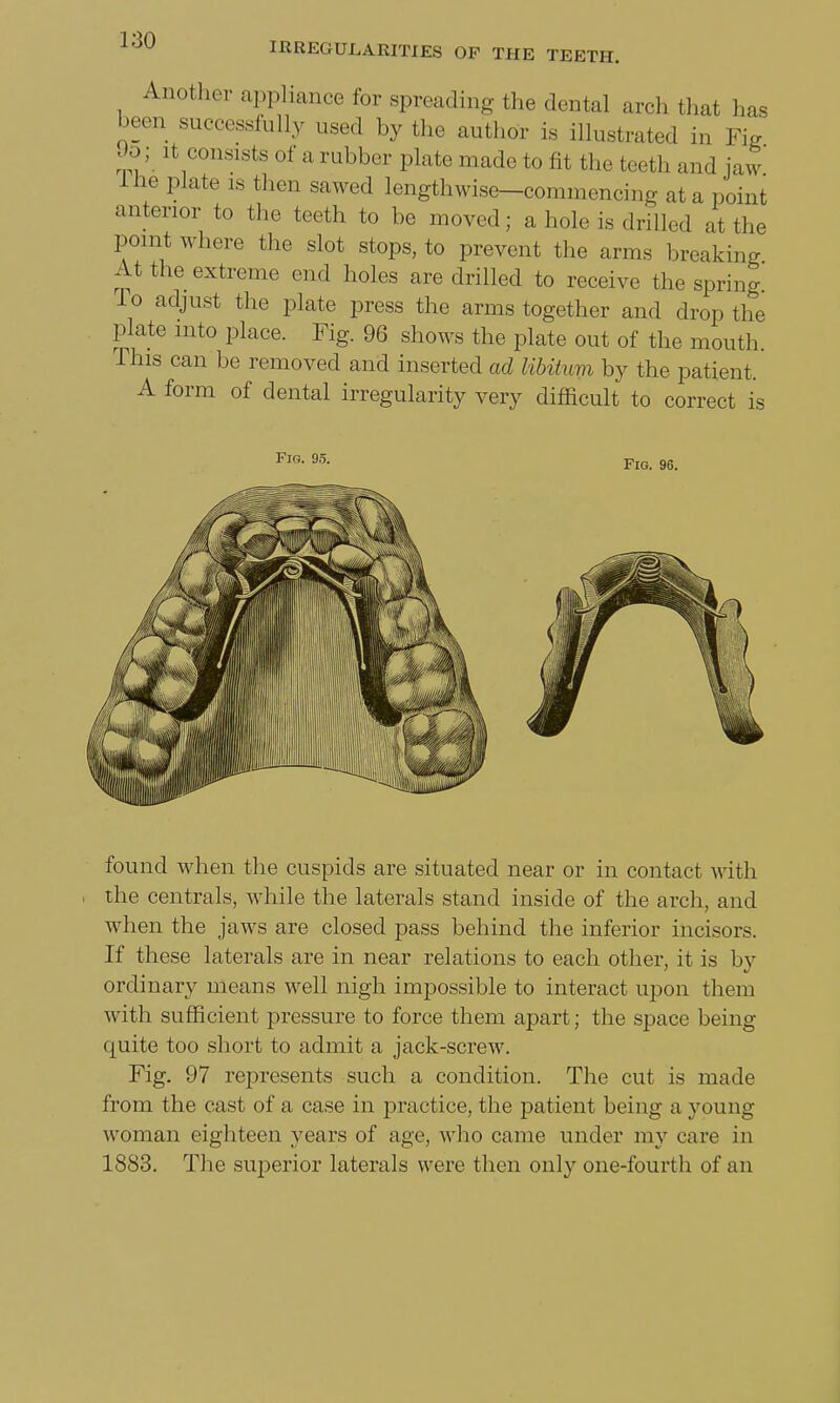 Another appliance for spreading the dental arch that has been successfully used by the author is illustrated in Fig . . .; it consists of a rubber plate made to fit the teeth and jaw ine plate is then sawed lengthwise—commencing at a point anterior to the teeth to be moved; a hole is drilled at the point where the slot stops, to prevent the arms breaking At the extreme end holes are drilled to receive the spring. To adjust the plate press the arms together and drop the plate into place. Fig. 96 shows the plate out of the mouth. This can be removed and inserted ad libitum by the patient, A form of dental irregularity very difficult to correct is found when the cuspids are situated near or in contact with , the centrals, while the laterals stand inside of the arch, and when the jaws are closed pass behind the inferior incisors. If these laterals are in near relations to each other, it is by ordinary means well nigh impossible to interact upon them with sufficient pressure to force them apart; the space being quite too short to admit a jack-screw. Fig. 97 represents such a condition. The cut is made from the cast of a case in practice, the patient being a }roung woman eighteen years of age, who came under my care in 1883. The superior laterals were then only one-fourth of an
