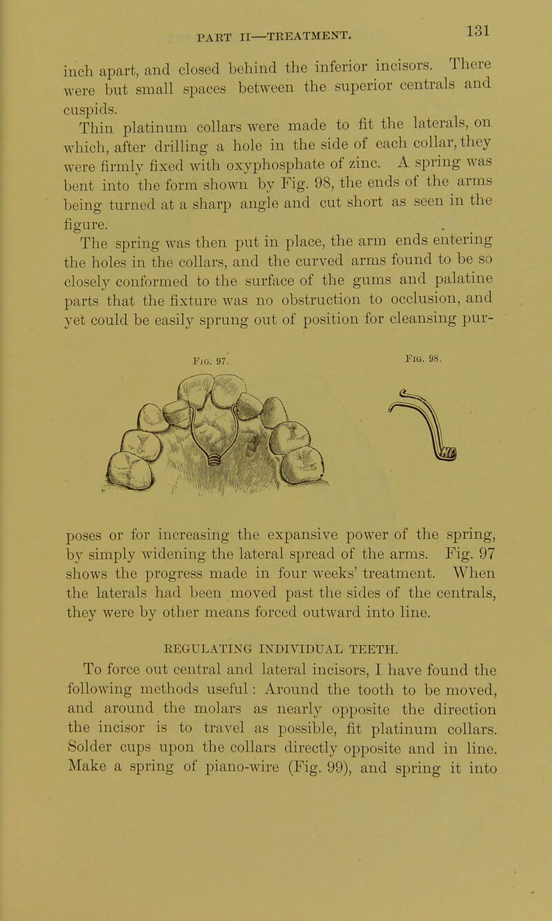 inch apart, and closed behind the inferior incisors. There were but small spaces between the superior centrals and cuspids. Thin platinum collars were made to fit the laterals, on which, after drilling a hole in the side of each collar, they were firmly fixed with oxyphosphate of zinc. A spring was bent into the form shown by Fig. 98, the ends of the arms being turned at a sharp angle and cut short as seen in the figure. The spring was then put in place, the arm ends entering the holes in the collars, and the curved arms found to be so closely conformed to the surface of the gums and palatine parts that the fixture was no obstruction to occlusion, and yet could be easily sprung out of position for cleansing pur- Fig. 97. Fig. 98. poses or for increasing the expansive power of the spring, by simply widening the lateral spread of the arms. Fig. 97 shows the progress made in four weeks' treatment. When the laterals had been moved past the sides of the centrals, they were by other means forced outward into line. REGULATING INDIVIDUAL TEETH. To force out central and lateral incisors, I have found the following methods useful: Around the tooth to be moved, and around the molars as nearly opposite the direction the incisor is to travel as possible, fit platinum collars. Solder cups upon the collars directly opposite and in line. Make a spring of piano-wire (Fig. 99), and spring it into