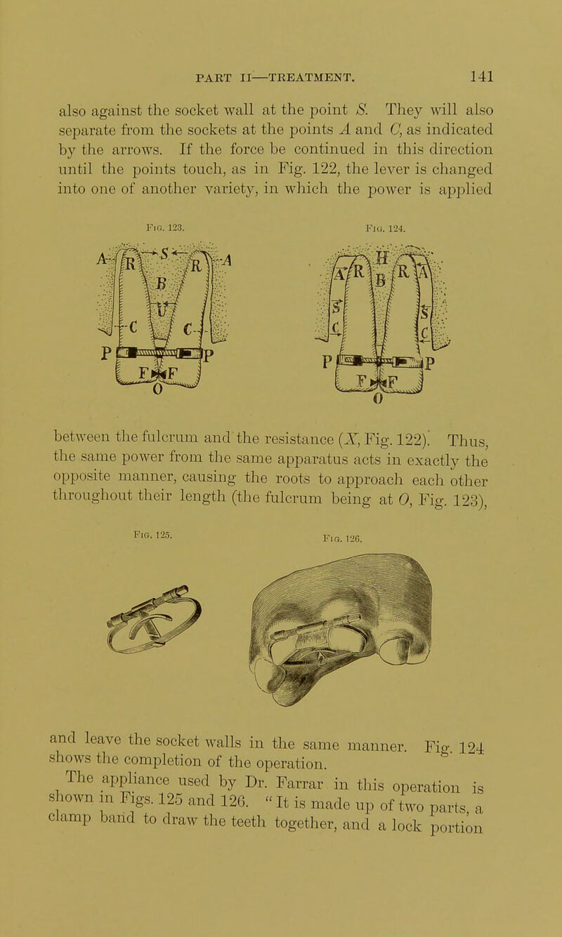 also against the socket wall at the point S. They will also separate from the sockets at the points A and C, as indicated by the arrows. If the force be continued in this direction until the points touch, as in Fig. 122, the lever is changed into one of another variety, in which the power is applied Fig. 123. Fia. 124. between the fulcrum and the resistance (X, Fig. 122).' Thus, the same power from the same apparatus acts in exactly the opposite manner, causing the roots to approach each other throughout their length (the fulcrum being at 0, Fig. 123), and leave the socket walls in the same manner. Fig 194 shows the completion of the operation. The appliance used by Dr. Farrar in this operation is shown m Figs. 125 and 12G. «It is made up of two parts, a clamp band to draw the teeth together, and a lock portion