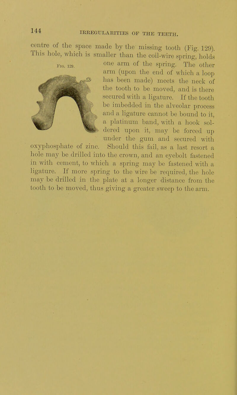 Via. 129. centre of the space made by the missing tooth (Fig. 129). This hole, which is smaller than the coil-wire spring, holds one arm of the spring. The other arm (upon the end of which a loop has been made) meets the neck of the tooth to be moved, and is there secured with a ligature. If the tooth be imbedded in the alveolar process and a ligature cannot be bound to it, a platinum hand, with a hook sol- dered upon it, may be forced up under the gum and secured with oxyphosphate of zinc. Should this fail, as a last resort a hole may be drilled into the crown, and an eyebolt fastened in with cement, to which a spring may be fastened with a ligature. If more spring to the wire be required, the hole may he drilled in the plate at a longer distance from the tooth to be moved, thus giving a greater sweep to the arm.