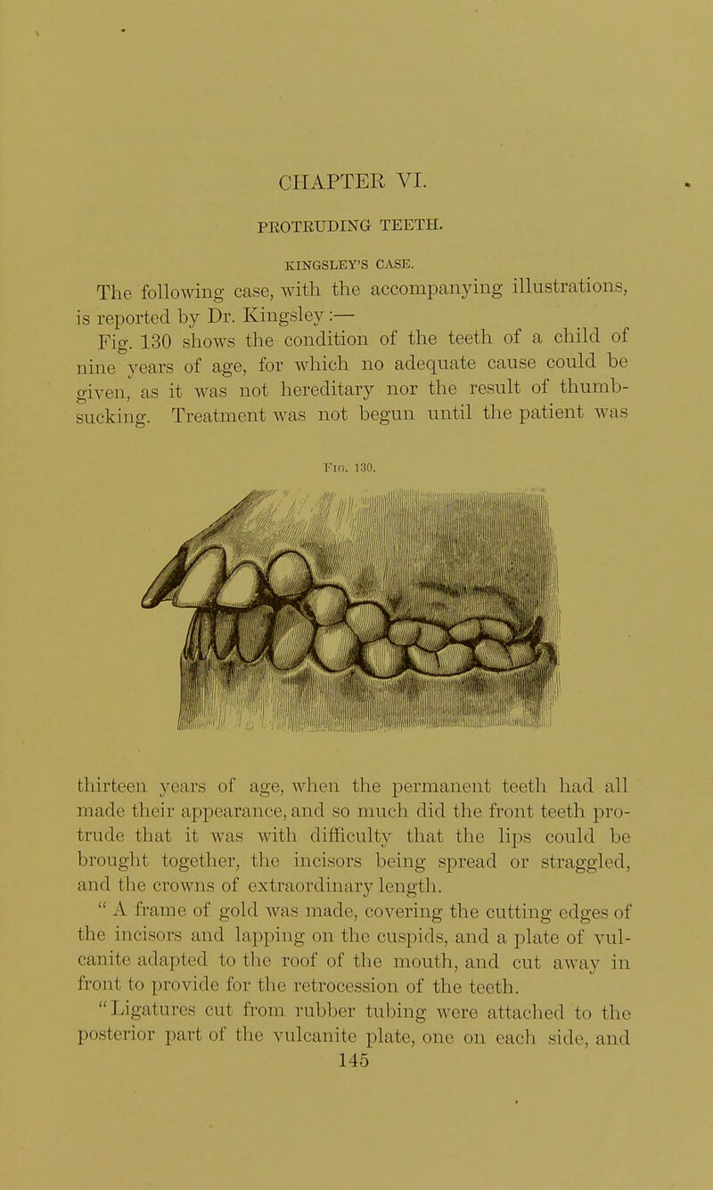 CHAPTER VI. PROTRUDING TEETH. KINGSLEY'S CASE. The following case, with the accompanying illustrations, is reported by Dr. Kingsley:— Fig. 130 shows the condition of the teeth of a child of nine years of age, for which no adequate cause could be given, as it was not hereditary nor the result of thumb- sucking. Treatment was not begun until the patient was Fig. 130. thirteen years of age, when the permanent teeth had all made their appearance, and so much did the front teeth pro- trude that it was with difficulty that the lips could be brought together, the incisors being spread or straggled, and the crowns of extraordinary length .  A frame of gold was made, covering the cutting edges of the incisors and lapping on the cuspids, and a plate of vul- canite adapted to the roof of the mouth, and cut away in front to provide for the retrocession of the teeth. Ligatures cut from rubber tubing were attached to the posterior part of the vulcanite plate, one on each side, and