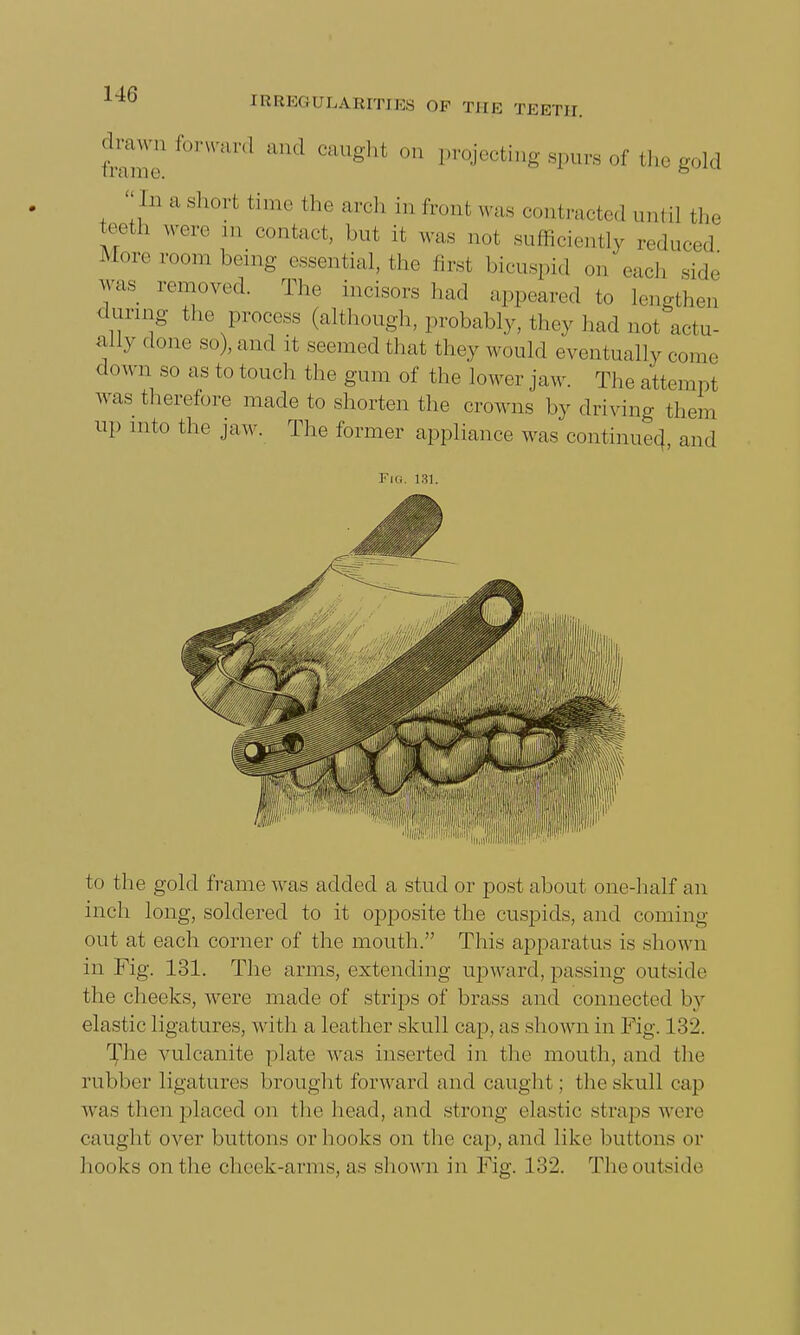 drawn forward and caught on projecting spurs of the gold In a short time the arch in front was contracted until the fth *** 1,1 cont^ but it was not sufficiently reduced More room being essential, the first bicuspid on each side T. ren!oyed- Tlu' [™sorS had appeared to lengthen during the process (although, probably, they had not actu- ally done so), and it seemed that they would eventually come down so as to touch the gum of the lower jaw. The attempt was therefore made to shorten the crowns by driving them up into the jaw. The former appliance was continued,, and Fig. 131. to the gold frame was added a stud or post about one-half an inch long, soldered to it opposite the cuspids, and coming out at each corner of the mouth. This apparatus is shown in Fig. 131. The arms, extending upward, passing outside the cheeks, were made of strips of brass and connected by elastic ligatures, with a leather skull cap, as shown in Fig. 132. The vulcanite plate was inserted in the month, and the rubber ligatures brought forward and caught ; the skull cap was then placed on the head, and strong elastic straps were caught over buttons or hooks on the cap, and like buttons or hooks on the cheek-arms, as shown in Fig. 132. Theoutside