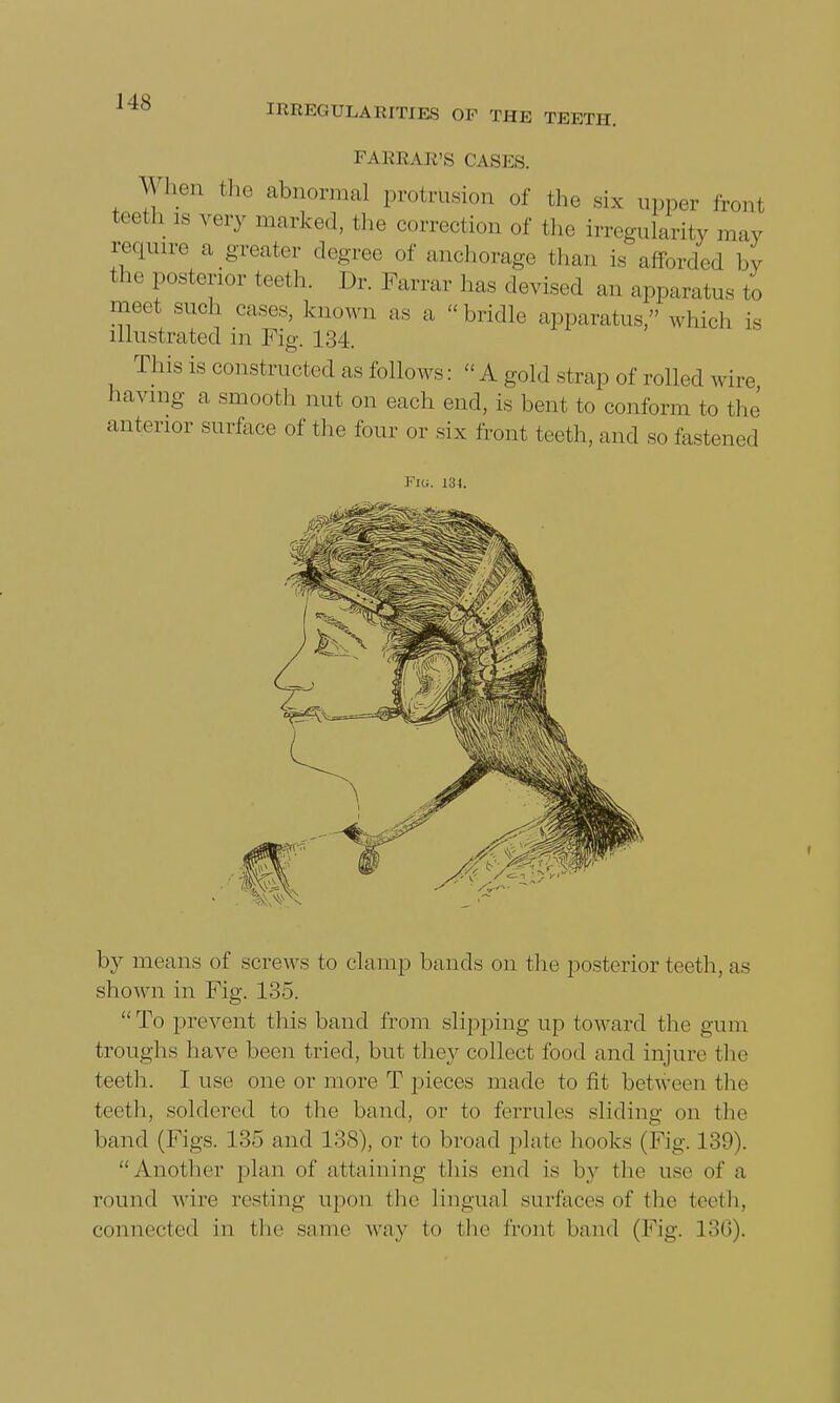 CBREGULAEITIE8 OF THE TEETH. FA HRA U\S CASKS. When the abnormal protrusion of the six upper front teeth ls vevy marked, the correction of the irregularity may require a greater degree of anchorage than is afforded by the posterior teeth. Dr. Farrar has devised an apparatus to meet such cases, known as a bridle apparatus, which is illustrated in Fig. 134. This is constructed as fellows:  A gold strap of rolled wire having a smooth nut on each end, is bent to conform to the anterior surface of the four or six front teeth, and so fastened Fro. 134. by means of screws to clamp bands on the posterior teeth, as shown in Fig. 135. To prevent this band from slipping up toward the gum troughs have been tried, but they collect food and injure the teeth. I use one or more T pieces made to fit between the teeth, soldered to the band, or to ferrules sliding oe the band (Figs. 135 and 138), or to broad plate hooks ( Fig. 139). Another plan of attaining this end is by the use of a round wire resting upon the lingual surfaces of the teeth, connected in the same way to the front hand (Fig. L36).