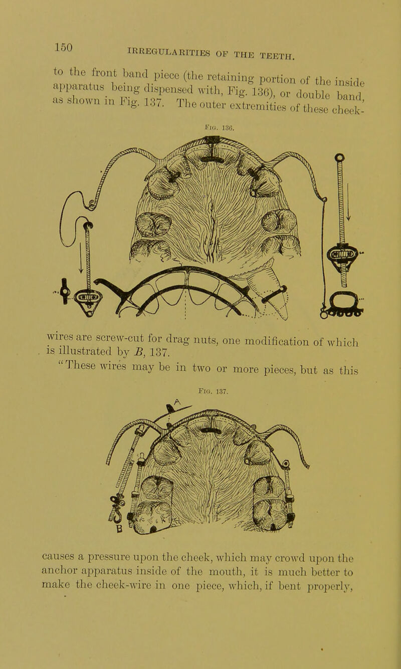 to the front band piece (the retaining portion of the inside apparatus being dispensed with, Fig. L36) or doiiM - shown in Fig. 137. The outer J^J^g* Era. 136. wires are screw-cut for drag nuts, one modification of which is illustrated by B, 137. These wires may be in two or more pieces, but as this Fig. 137. causes a pressure upon the cheek, which may crowd upon the anchor apparatus.inside of the mouth, ii is much better to make the check-wire in one piece, which,if bent properly,