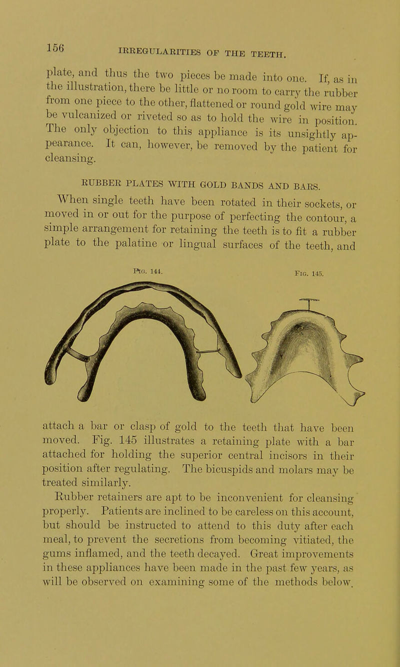 plate, and thus the two pieces be made into one [f as in the illustration, there be little or no room to carry the rubber from one piece to the other, flattened or round gold wire may be vulcanized or riveted so as to hold the wire in position The only objection to this appliance is its unsightly ap- pearance. It can, however, be removed by the patient for cleansing. RUBBER PLATES WITH GOLD BANDS AND BARS. When single teeth have been rotated in their sockets, or moved in or out for the purpose of perfecting the contour, a simple arrangement for retaining the teeth is to fit a rubber plate to the palatine or lingual surfaces of the teeth, and Pm. 144. Fro. 145. attach a bar or clasp of gold to the teeth that have been moved. Fig. 145 illustrates a retaining plate with a bar attached for holding the superior central incisors in their position after regulating. The bicuspids and molars may be treated similarly. Rubber retainers are apt to be inconvenient for cleansing properly. Patients are inclined to be careless on this accou ut, but should be instructed to attend to this duty after each meal, to prevent the secretions from becoming vitiated, the gums inflamed, and the teeth decayed. Great improvements in these appliances have been made in the past few years, as will be observed on examining some of the methods below.