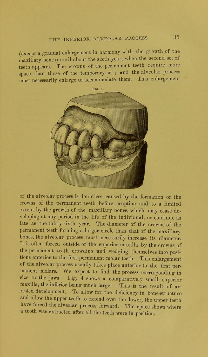 (except a gradual enlargement in harmony with the growth of the maxillary bones) until about the sixth year, when the second set of teeth appears. The crowns of the permanent teeth require more space than those of the temporary set; and the alveolar process must necessarily enlarge to accommodate them. This enlargement Fig. 4. of the alveolar process is doubtless caused by the formation of the crowns of the permanent teeth before eruption, and to a limited extent by the growth of the maxillary bones, which may cease de- veloping at any period in the life of the individual, or continue as late as the thirty-sixth year. The diameter of the crowns of the permanent teeth forming a larger circle than that of the maxillary bones, the alveolar process must necessarily increase its diameter. It is often forced outside of the superior maxilla by the crowns of the permanent teeth crowding and wedging themselves into posi- tions anterior to the first permanent molar teeth. This enlargement of the alveolar process usually takes place anterior to the fiirst per- manent molars. We expect to find the process corresponding in size to the jaws. Fig. 4 shows a comparatively small superior maxilla, the inferior being much larger. This is the result of ar- rested development. To allow for the deficiency in bone-structure and allow the upper teeth to extend over the lower, the upper teeth have forced the alveolar process forward. The space shows where a tooth was extracted after all the teeth were in position. i