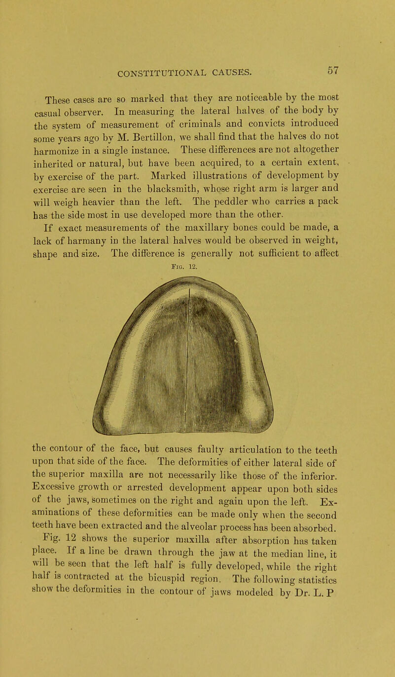 These cases are so marked that they are noticeable by the most casual observer. In measuring the lateral halves of the body by the system of measurement of criminals and convicts introduced some years ago by M. Bertillon, we shall find that the halves do not harmonize in a single instance. These differences are not altogether inherited or natural, but have been acquired, to a certain extent, by exercise of the part. Marked illustrations of development by exercise are seen in the blacksmith, whose right arm is larger and will weigh heavier than the left. The peddler who carries a pack has the side most in use developed more than the other. If exact measurements of the maxillary bones could be made, a lack of harmany in the lateral halves would be observed in weight, shape and size. The difference is generally not sufficient to affect Fig. 12. the contour of the face, but causes faulty articulation to the teeth upon that side of the face. The deformities of either lateral side of the superior maxilla are not necessarily like those of the inferior. Excessive growth or arrested development appear upon both sides of the jaws, sometin)es on the right and again upon the left. Ex- aminations of these deformities can be made only when the second teeth have been extracted and the alveolar process has been absorbed. Eig. 12 shows the superior maxilla after absorption has taken place. If a line be drawn through the jaw at the median line, it will be seen that the left half is fully developed, while the right half is contracted at the bicuspid region. The following statistics show the deformities in the contour of jaws modeled by Dr. L. P