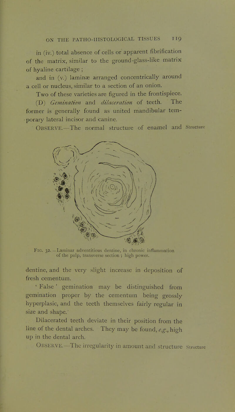 in (iv.) total absence of cells or apparent fibrification of the matrix, similar to the ground-glass-like matrix of hyaline cartilage ; and in (v.) laminae arranged concentrically around a cell or nucleus, similar to a section of an onion. Two of these varieties are figured in the frontispiece. (D) Gemination and dilaceration of teeth. The former is generally found as united mandibular tem- porary lateral incisor and canine. Observe.—The normal structure of enamel and Structure Fig. 32. —Laminar adventitious dentine, in chronic inllammatioii of the pulp, transverse section ; iiigh power. dentine, and the very slight increase in deposition of fresh cementum. ' False ' gemination may be distinguished from gemination proper by the cementum being grossly hyperplasic, and the teeth themselves fairly regular in size and shape. Dilacerated teeth deviate in their position from the line of the dental arches. They may be found, e.g., high up in the dental arch. OnSERVE.—The irregularity in amount and structure Structure