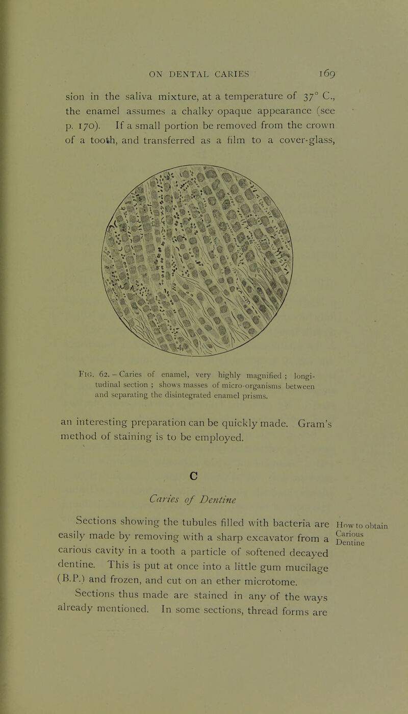 sion in the saliva mixture, at a temperature of 37° C, the enamel assumes a chalky opaque appearance (see p. 170). If a small portion be removed from the crown of a tooth, and transferred as a film to a cover-glass, Fu;. 62. - Caries of enamel, very highly magnified ; longi- tudinal section ; shows masses of micro-organisms between and separating the disintegrated enamel prisms. an interesting preparation can be quickly made. Gram's method of staining is to be employed. C Caries of Dentine Sections showing the tubules filled with bacteria are Howtoohta easily made by removing with a sharp excavator from a DeminJ carious cavity in a tooth a particle of softened decayed dentine. This is put at once into a little gum mucilage (B.P.) and frozen, and cut on an ether microtome. Sections thus made are stained in any of the ways already mentioned. In some sections, thread forms are