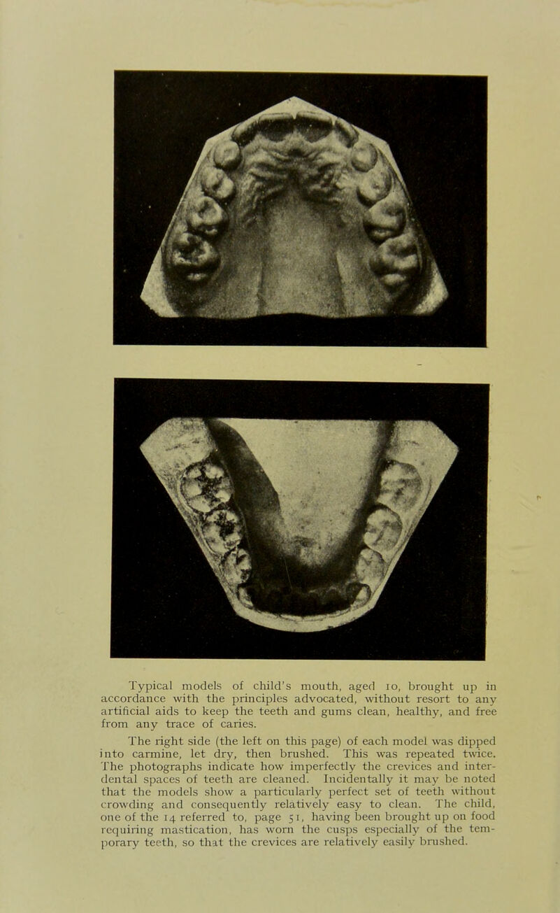 Typical models of child's mouth, aged lo, brought up in accordance with the principles advocated, without resort to any artificial aids to keep the teeth and gums clean, healthy, and free from any trace of caries. The right side (the left on this page) of each model was dipped into carmine, let dry, then brushed. This was repeated twice. The photographs indicate how imperfectly the crevices and inter- dental spaces of teeth are cleaned. Incidentally it may be noted that the models show a particularly perfect set of teeth without crowding and consequently relatively easy to clean. The child, one of the 14 referred to, page 51, having heen brought up on food requiring mastication, has worn the cusps especially of the tem- porary teeth, so that the crevices are relatively easily brushed.