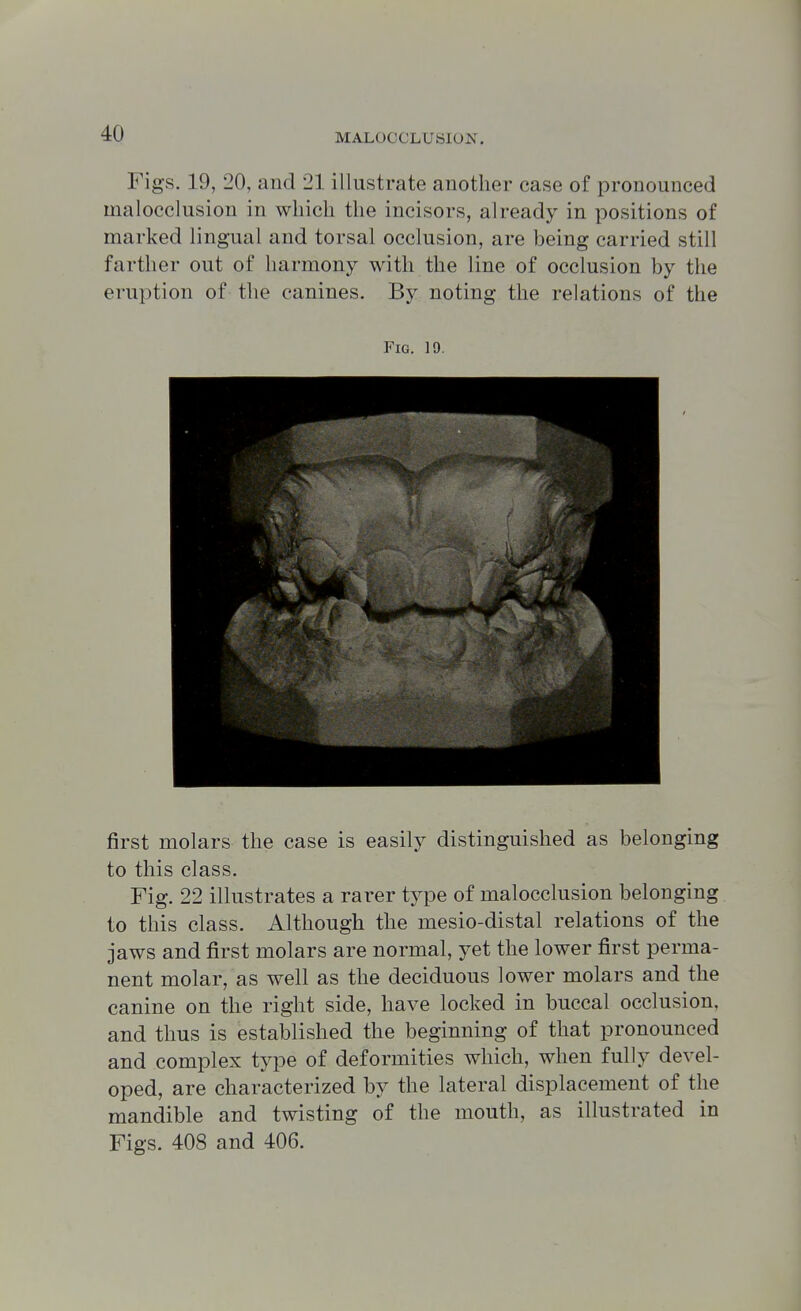 Figs. 19, 20, and 21 illustrate another case of pronounced malocclusion in which the incisors, already in positions of marked lingual and torsal occlusion, are being carried still farther out of harmony with the line of occlusion by the eruption of the canines. By noting the relations of the Fig. 19. first molars the case is easily distinguished as belonging to this class. Fig. 22 illustrates a rarer type of malocclusion belonging to this class. Although the mesio-distal relations of the jaws and first molars are normal, yet the lower first perma- nent molar, as well as the deciduous lower molars and the canine on the right side, have locked in buccal occlusion, and thus is established the beginning of that pronounced and complex type of deformities which, when fully devel- oped, are characterized by the lateral displacement of the mandible and twisting of the mouth, as illustrated in Figs. 408 and 406.