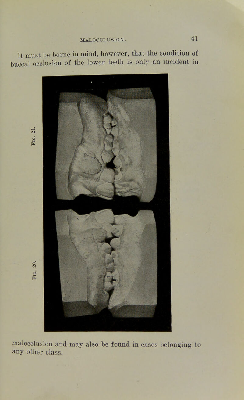 It must be borne in mind, however, that the condition of buccal occlusion of the lower teeth is only an incident in malocclusion and may also be found in cases belonging to any other class.