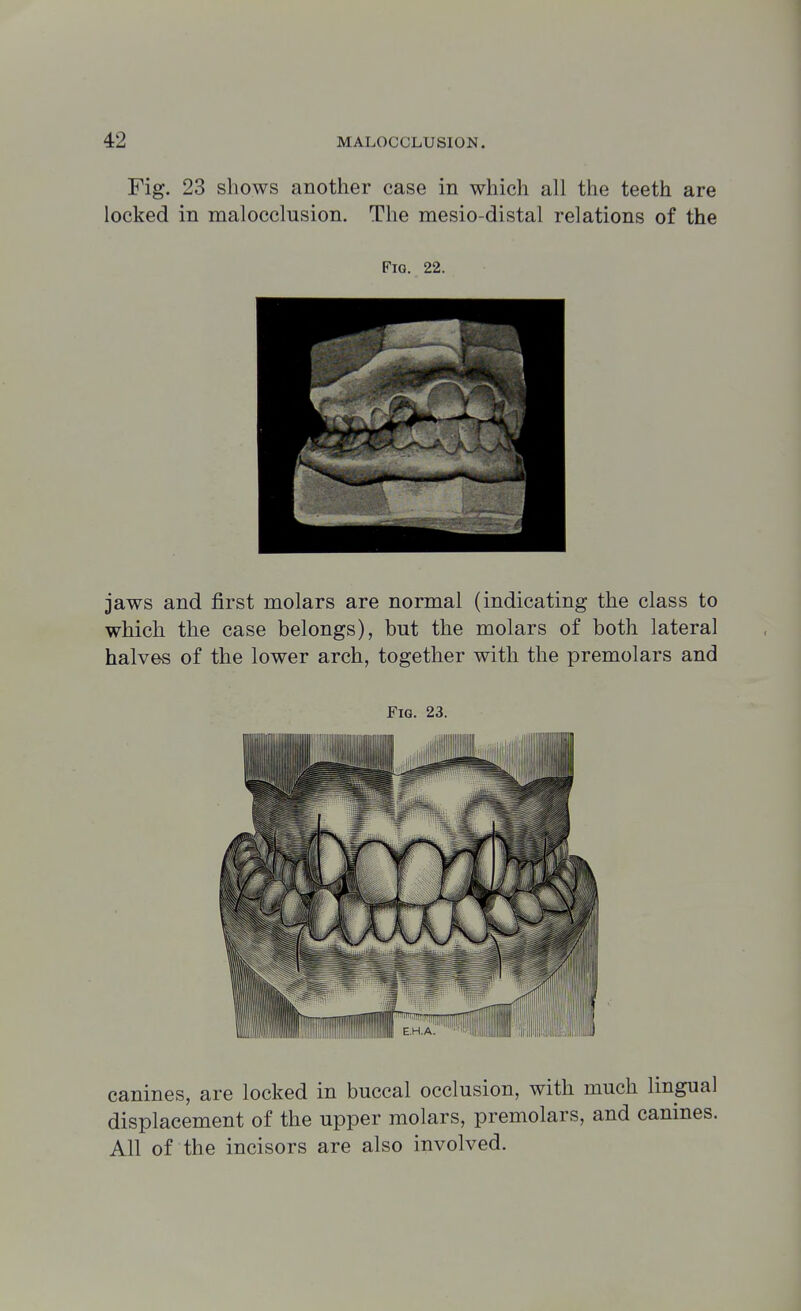 Fig. 23 shows another case in which all the teeth are locked in malocclusion. The mesio-distal relations of the Fig. 22. jaws and first molars are normal (indicating the class to which the case belongs), but the molars of both lateral halves of the lower arch, together with the premolars and Fig. 23. canines, are locked in buccal occlusion, with much lingual displacement of the upper molars, premolars, and canines. All of the incisors are also involved.