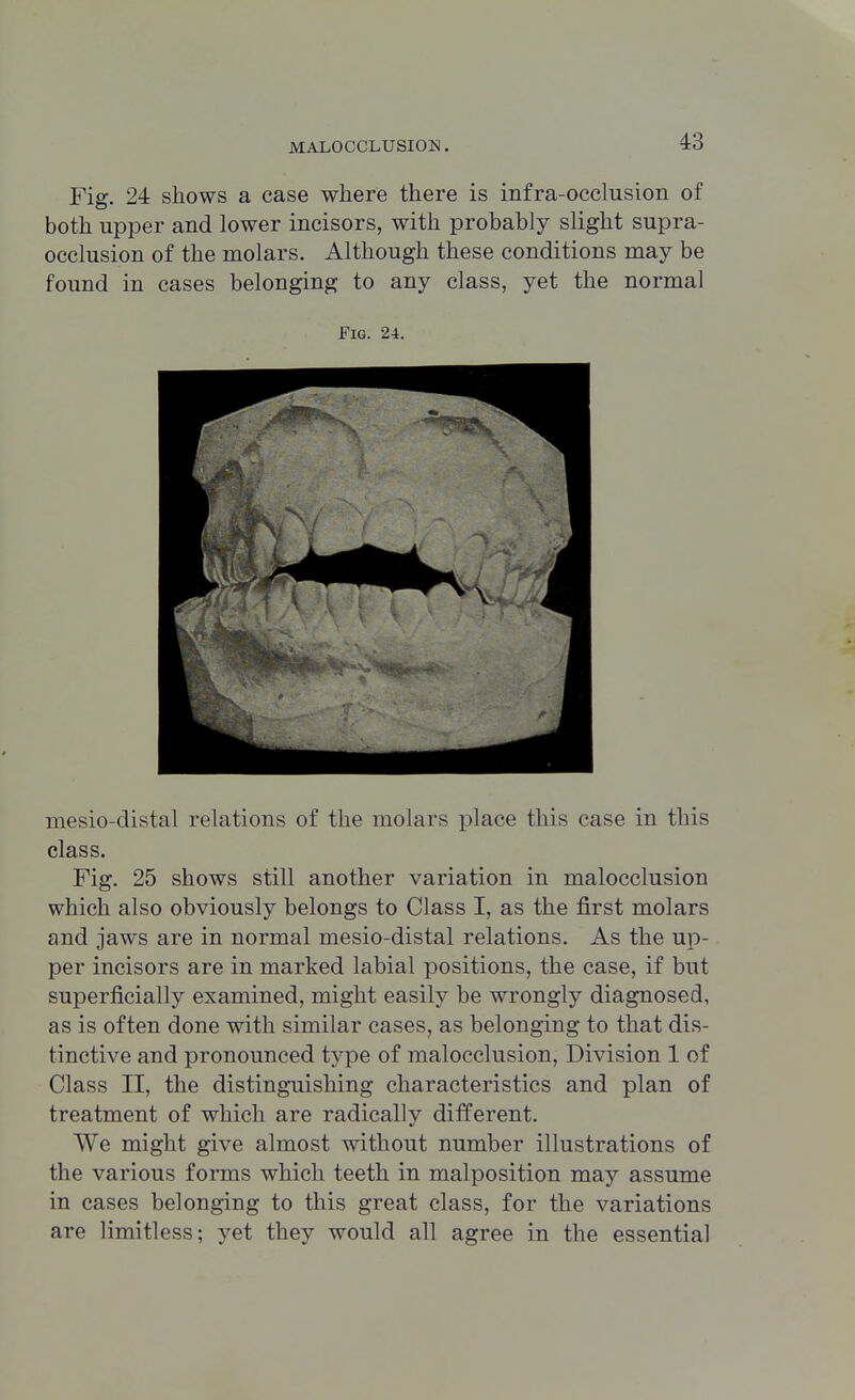 Fig. 24 shows a case where there is infra-occlusion of both upper and lower incisors, with probably slight supra- occlusion of the molars. Although these conditions may be found in cases belonging to any class, yet the normal Fig. 24. mesio-distal relations of the molars place this case in this class. Fig. 25 shows still another variation in malocclusion which also obviously belongs to Class I, as the first molars and jaws are in normal mesio-distal relations. As the up- per incisors are in marked labial positions, the case, if but superficially examined, might easily be wrongly diagnosed, as is often done with similar cases, as belonging to that dis- tinctive and pronounced type of malocclusion, Division 1 of Class II, the distinguishing characteristics and plan of treatment of which are radically different. We might give almost without number illustrations of the various forms which teeth in malposition may assume in cases belonging to this great class, for the variations are limitless; yet they would all agree in the essential