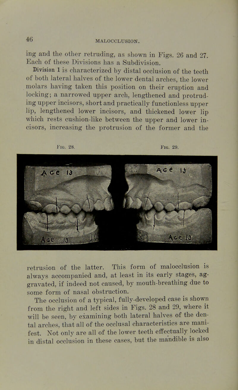 ing and the other retruding, as shown in Figs. 26 and 27. Each of these Divisions has a Subdivision. Division 1 is characterized by distal occlusion of the teeth of both lateral halves of the lower dental arches, the lower molars having taken this position on their eruption and locking; a narrowed upper arch, lengthened and protrud- ing upper incisors, short and practically functionless upper lip, lengthened lower incisors, and thickened lower lip which rests cushion-like between the upper and lower in- cisors, increasing the protrusion of the former and the retrusion of the latter. This form of malocclusion is always accompanied and, at least in its early stages, ag- gravated, if indeed not caused, by mouth-breathing due to some form of nasal obstruction. The occlusion of a typical, fully-developed case is shown from the right and left sides in Figs. 28 and 29, where it will be seen, by examining both lateral halves of the den- tal arches, that all of the occlusal characteristics are mani- fest. Not only are all of the lower teeth effectually locked in distal occlusion in these cases, but the mandible is also