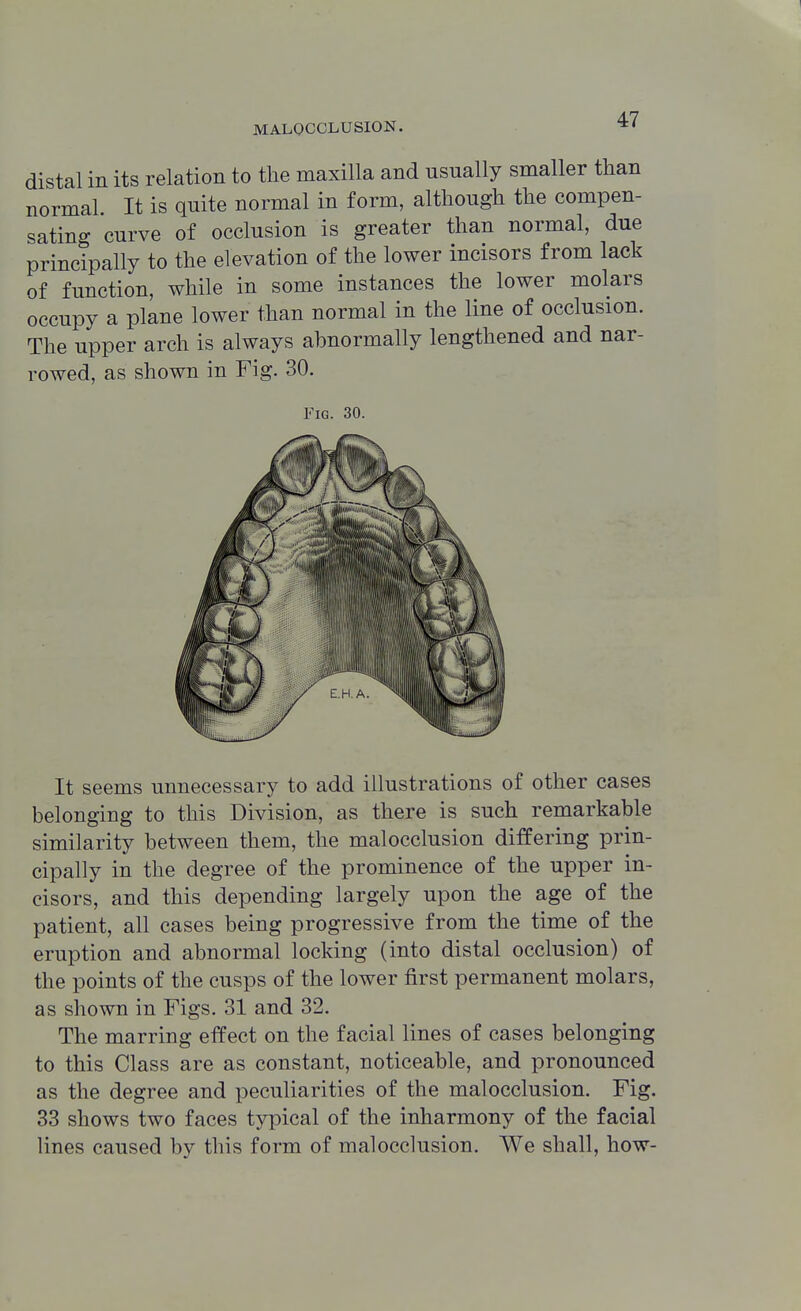 distal in its relation to the maxilla and usually smaller than normal It is quite normal in form, although the compen- sating curve of occlusion is greater than normal, due principally to the elevation of the lower incisors from lack of function, while in some instances the lower molars occupy a plane lower than normal in the line of occlusion. The upper arch is always abnormally lengthened and nar- rowed, as shown in Fig. 30. Fig. 30. It seems unnecessary to add illustrations of other cases belonging to this Division, as there is such remarkable similarity between them, the malocclusion differing prin- cipally in the degree of the prominence of the upper in- cisors, and this depending largely upon the age of the patient, all cases being progressive from the time of the eruption and abnormal locking (into distal occlusion) of the points of the cusps of the lower first permanent molars, as shown in Figs. 31 and 32. The marring effect on the facial lines of cases belonging to this Class are as constant, noticeable, and pronounced as the degree and peculiarities of the malocclusion. Fig. 33 shows two faces typical of the inharmony of the facial lines caused by this form of malocclusion. We shall, how-