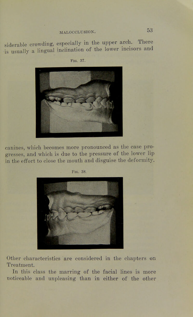 siderable crowdiug, especially in the upper arch. There is usually a lingual inclination of the lower mcisors and Fig. 37. canines, which becomes more pronounced as the case pro- gresses, and which is due to the pressure of the lower lip in the effort to close the mouth and disguise the deformity. Fig. 3S. Other characteristics are considered in the chapters on Treatment. In this class the marring of the facial lines is more noticeable and unpleasing than in either of the other