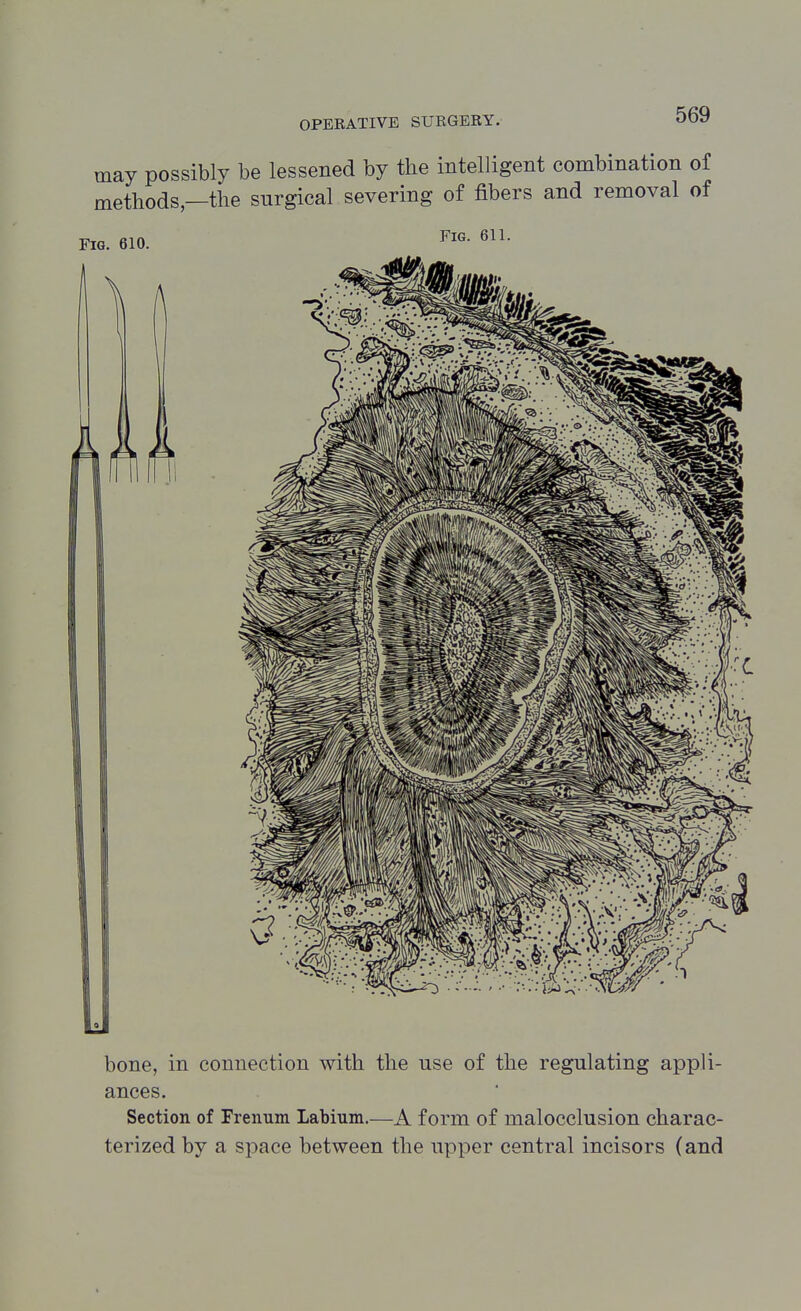 may possibly be lessened by the intelligent combination of methods—the surgical severing of fibers and removal of Fig. 610. Fig. 611. bone, in connection with the use of the regulating appli- ances. Section of Frenum Labium.—A form of malocclusion charac- terized by a space between the upper central incisors (and