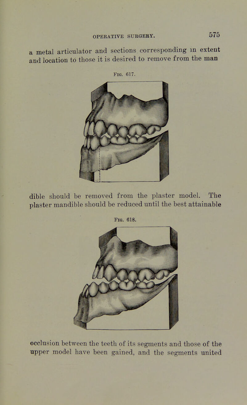 a metal articulator and sections corresponding m extent and location to those it is desired to remove from the man Fig. 617. dible should be removed from the plaster model. The plaster mandible should be reduced until the best attainable Fig. 618. occlusion between the teeth of its segments and those of the upper model have been gained, and the segments united