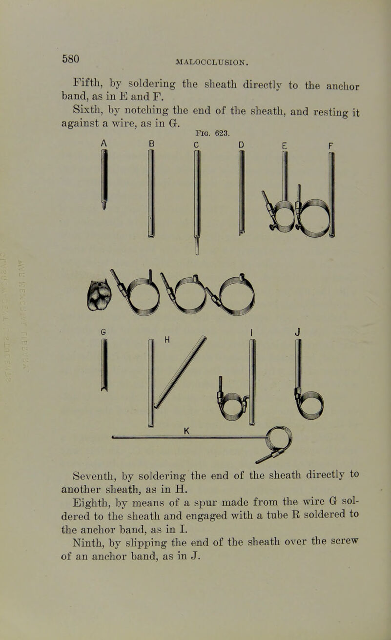 MALOCCLUSION. Fifth, by soldering the sheath directly to the anchor band, as in E and F. Sixth, by notching the end of the sheath, and resting it against a wire, as in Gr. B Fig. 623. C D 1 I Seventh, by soldering the end of the sheath directly to another sheath, as in H. Eighth, by means of a spur made from the wire G sol- dered to the sheath and engaged with a tube B soldered to the anchor band, as in I. Ninth, by slipping the end of the sheath over the screw of an anchor band, as in J.